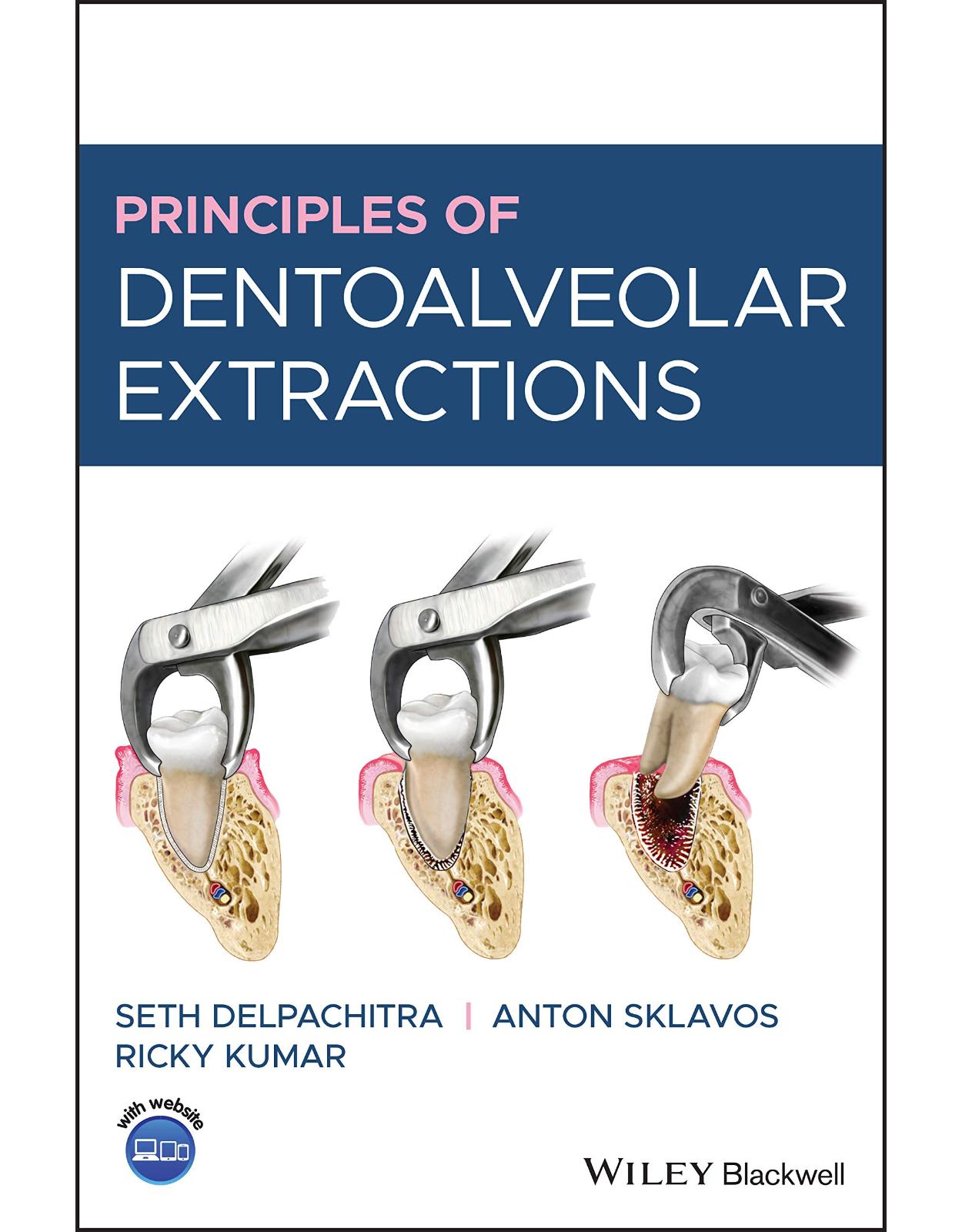 Principles of Dentoalveolar Extractions