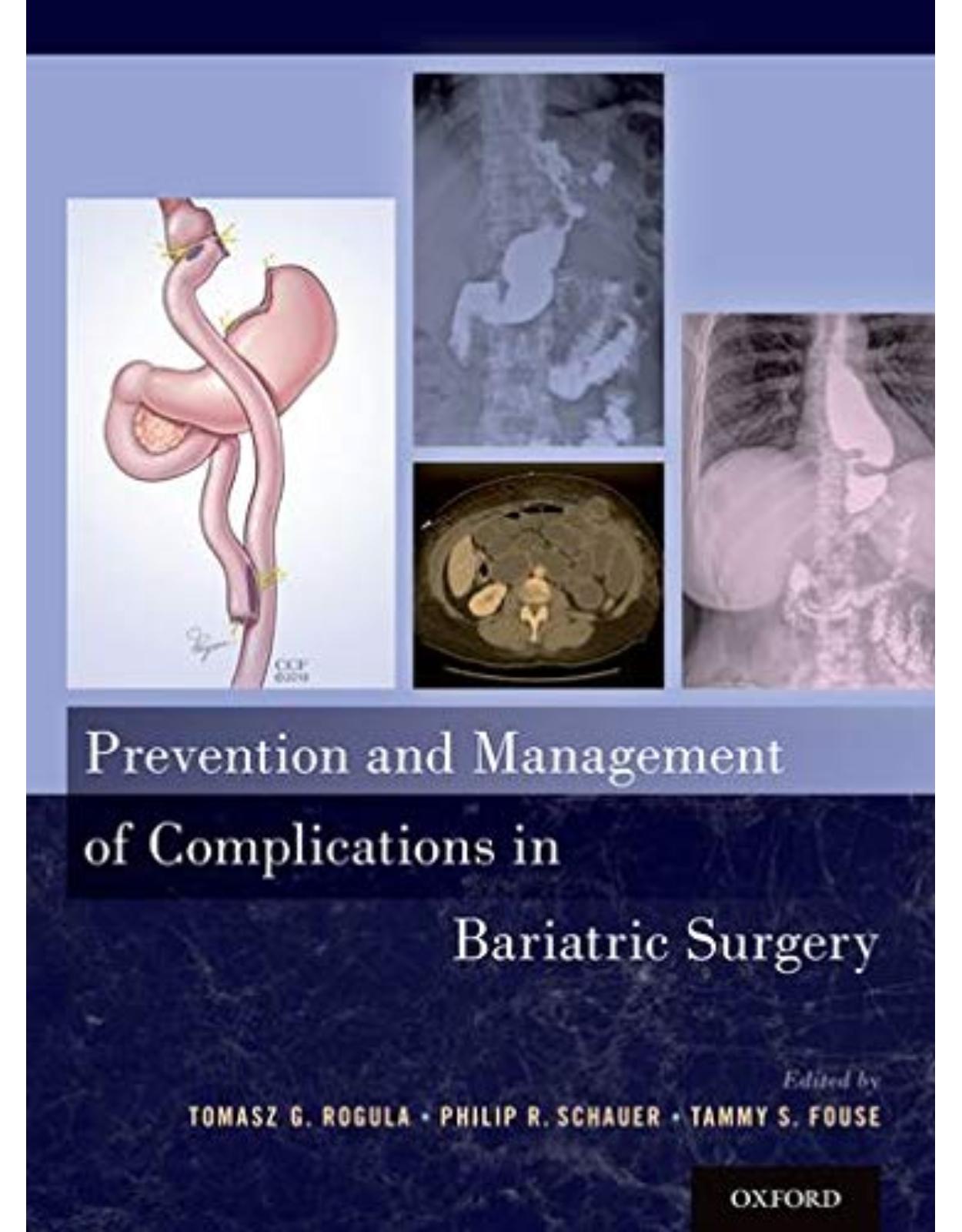 Prevention and Management of Complications in Bariatric Surgery