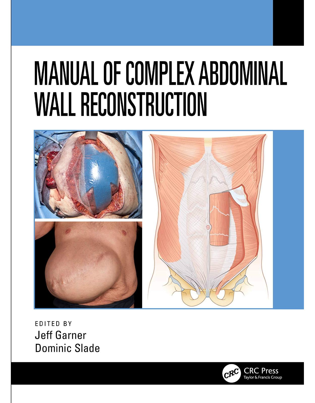 Manual of Complex Abdominal Wall Reconstruction 