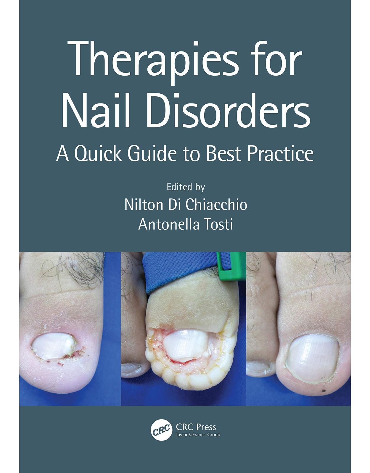 Therapies for Nail Disorders: A Quick Guide to Best Practice