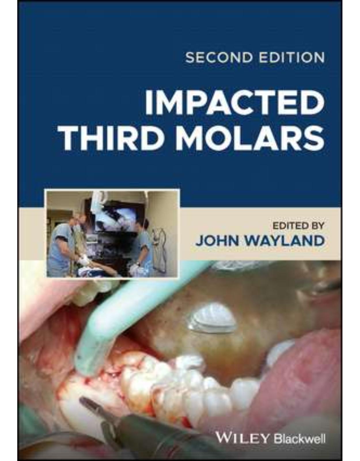 Impacted Third Molars, 2nd Edition