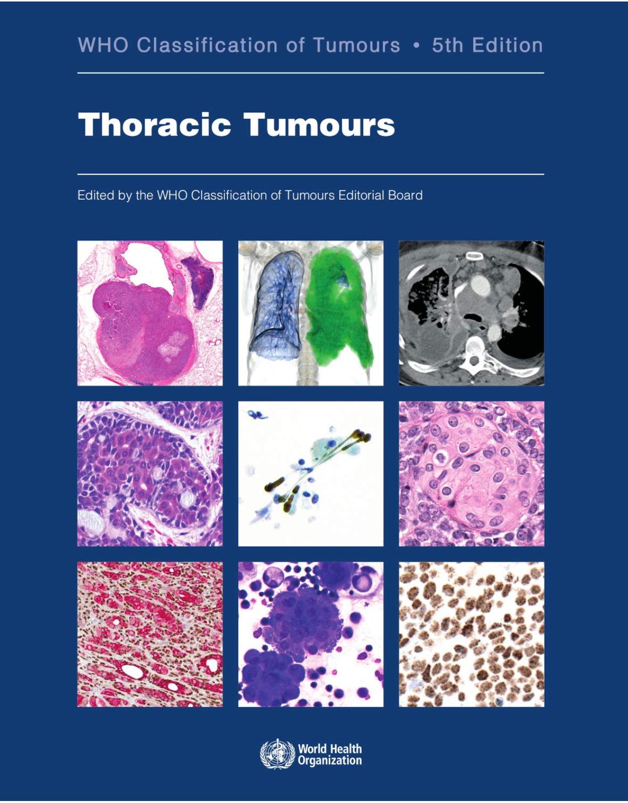 Thoracic tumours: Who Classification of Tumours 