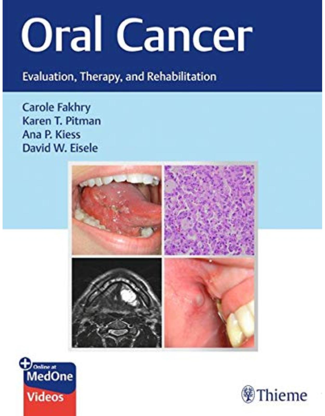 Oral Cancer: Evaluation, Therapy, and Rehabilitation 
