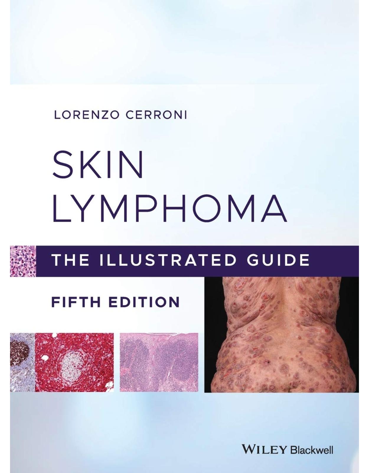 Skin Lymphoma: The Illustrated Guide