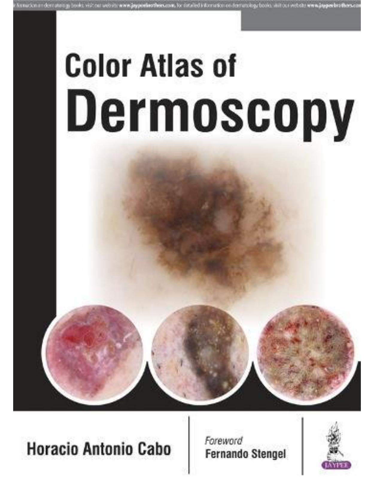 Color Atlas of Dermoscopy