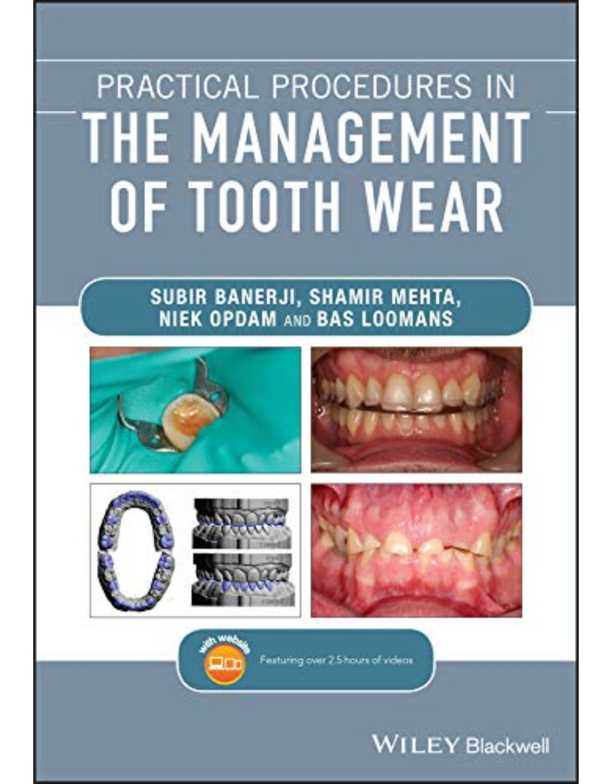 Practical Procedures in the Management of Tooth Wear