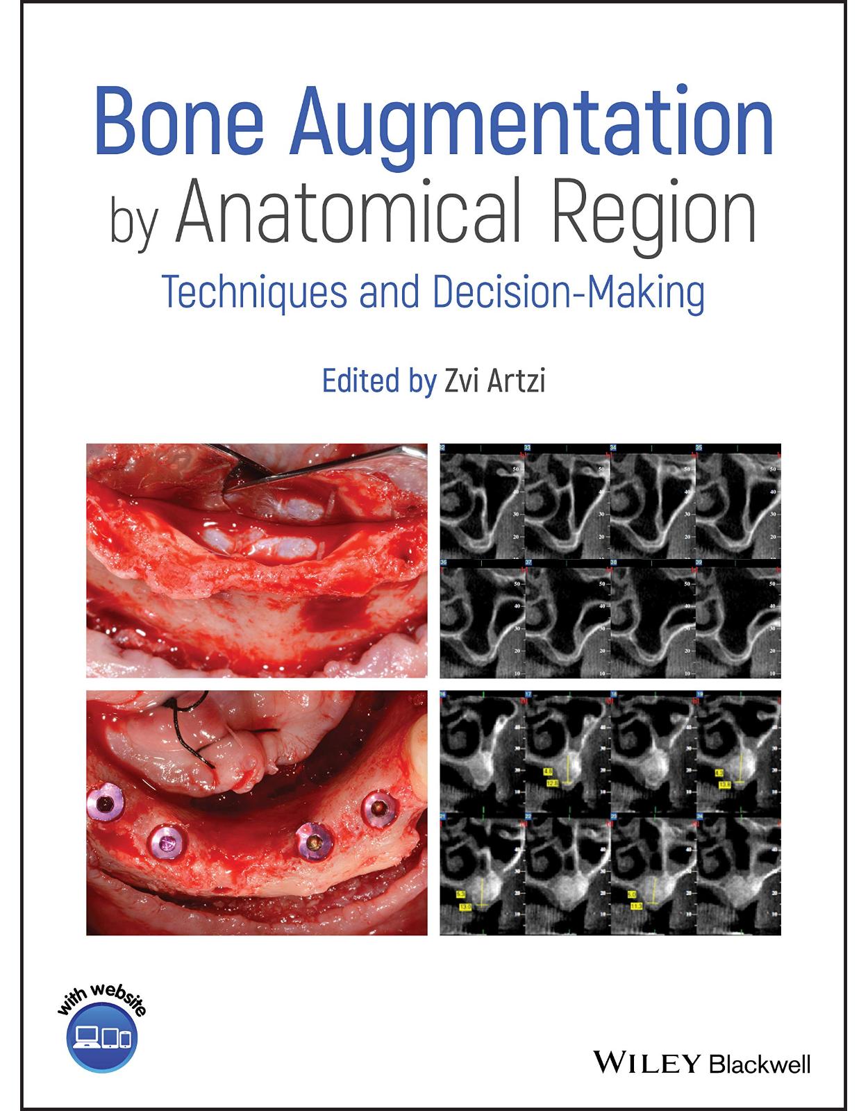 Bone Augmentation by Anatomical Region: Techniques and Decision–Making