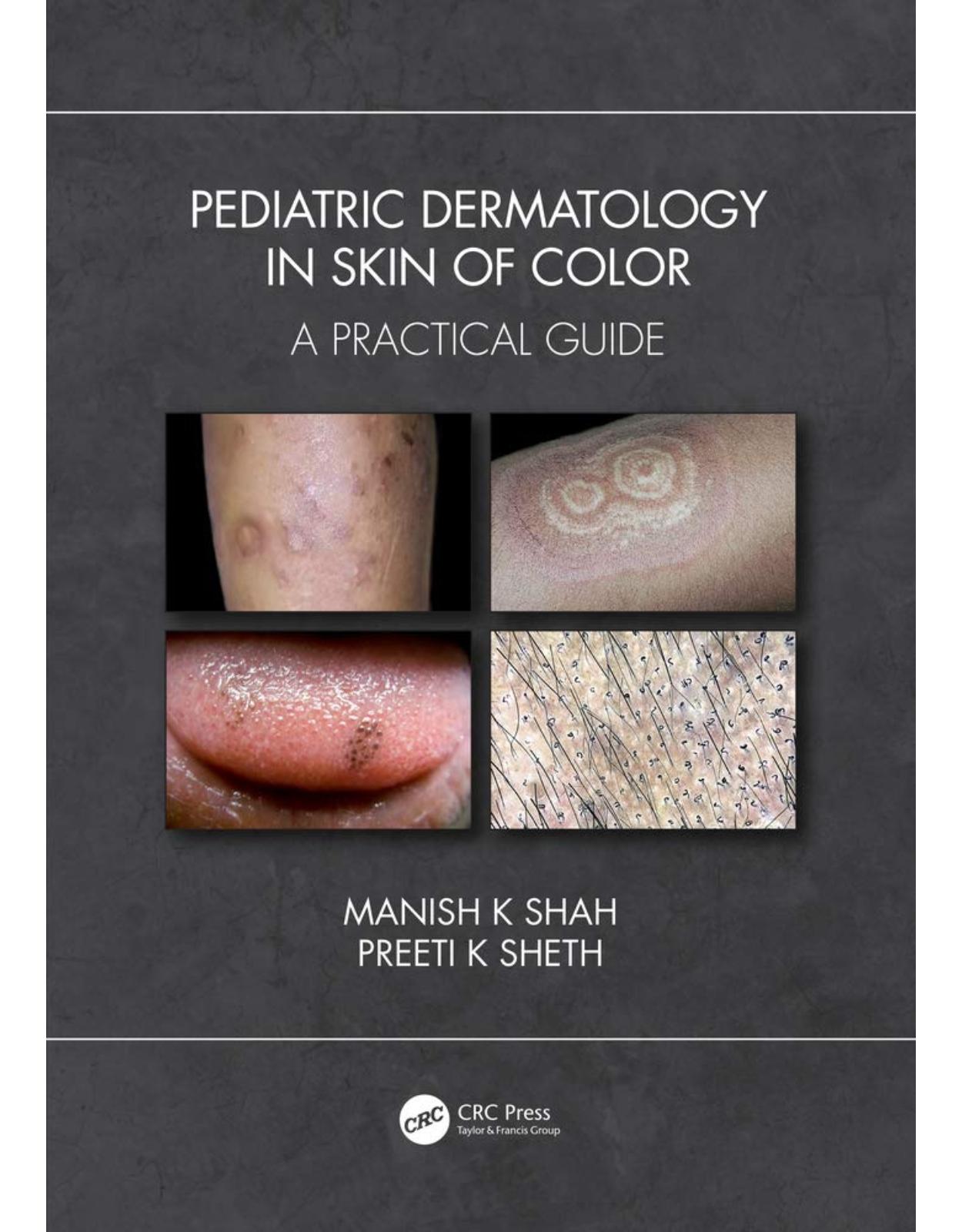 Pediatric Dermatology in Darker Skin
