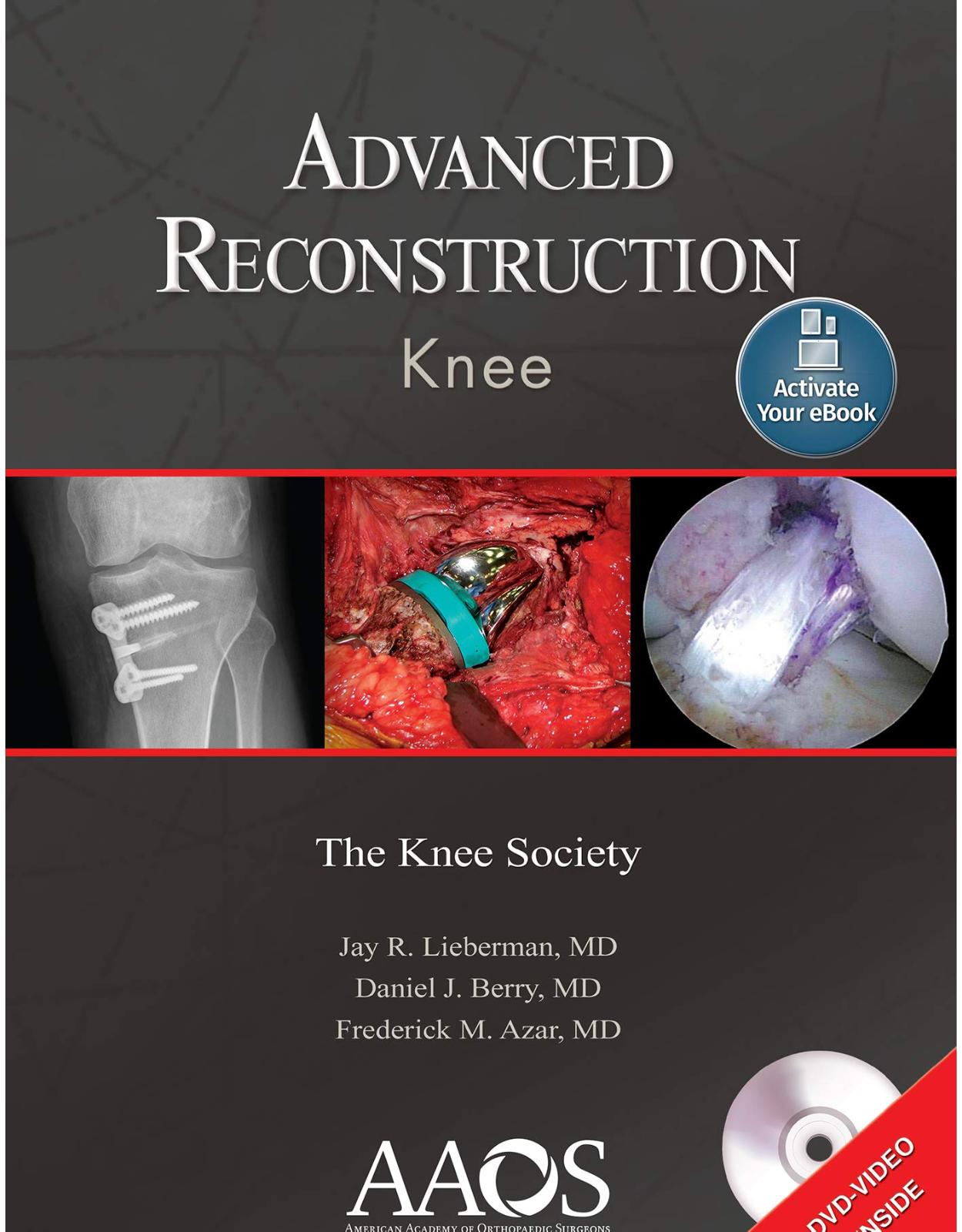 Advanced Reconstruction: Knee