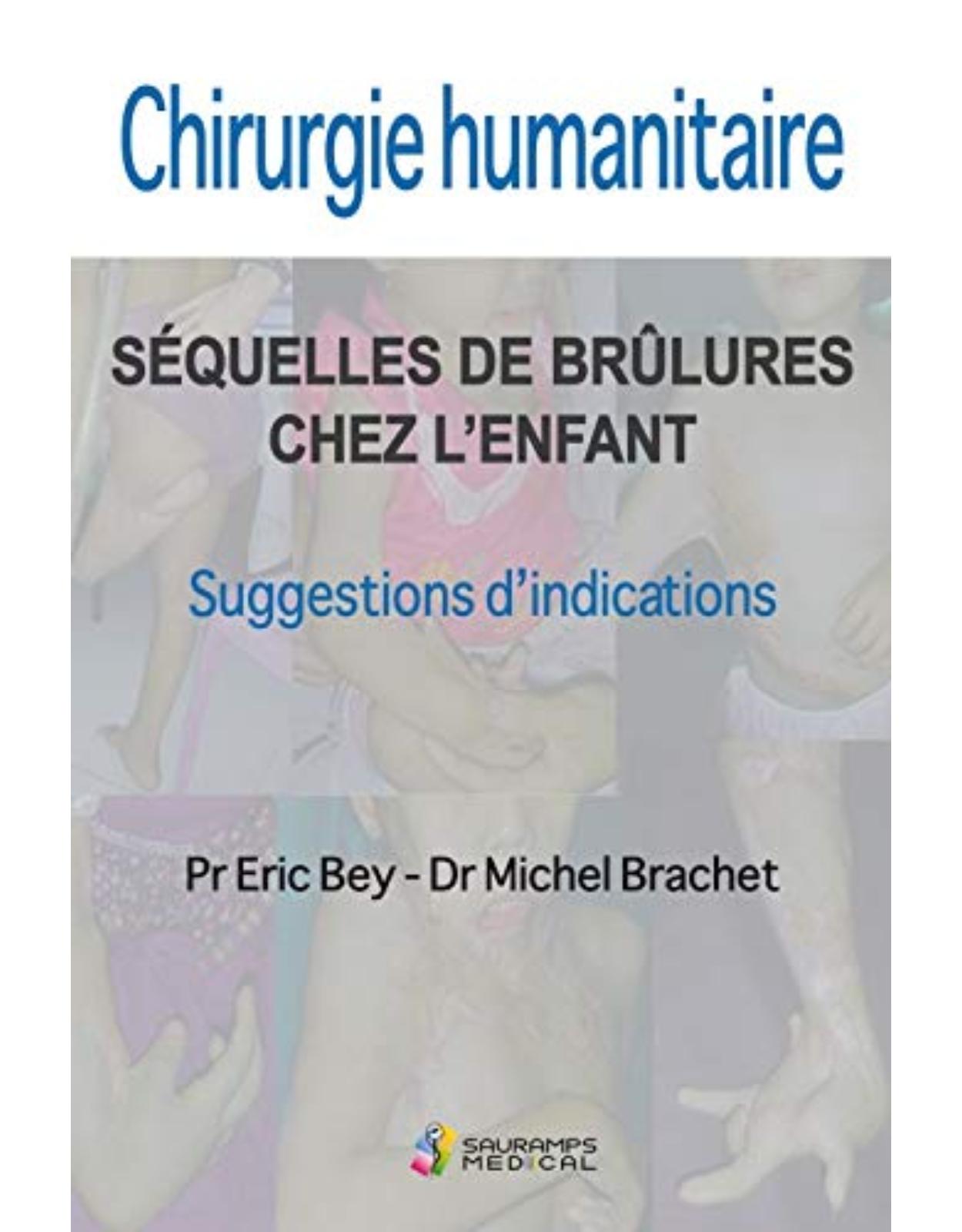 CHIRURGIE HUMANITAIRE. SEQUELLES DE BRULURES CHEZ L'ENFANT
