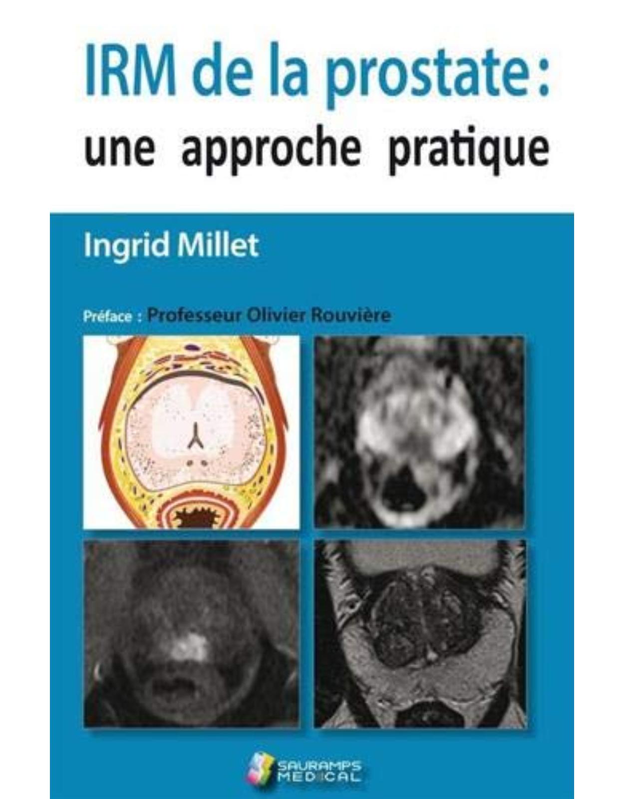 IRM DE LA PROSTATE