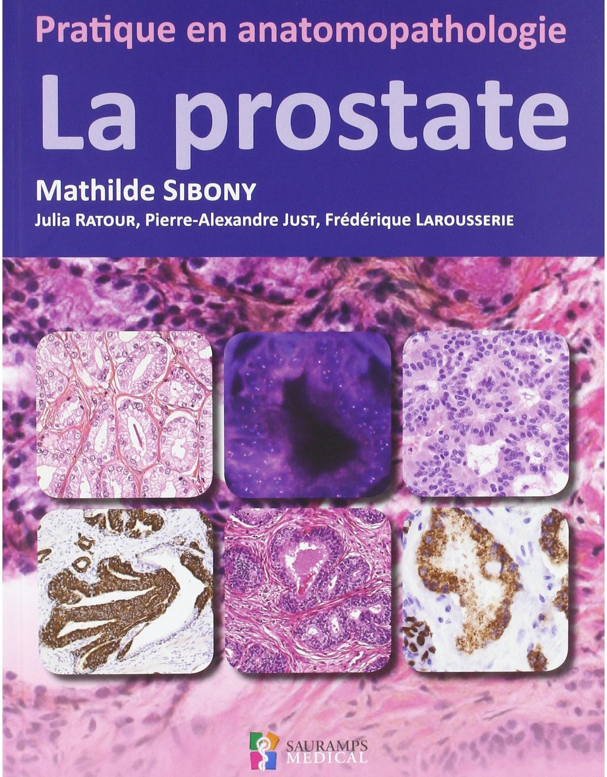 LA PROSTATE PRATIQUE EN ANATOMOPATHOLOGIE