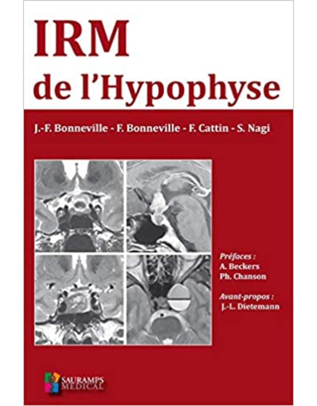 IRM DE L'HYPOPHYSE