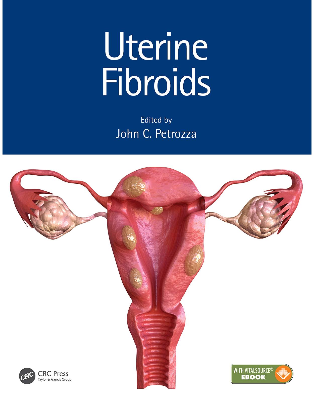 Uterine Fibroids (Reproductive Medicine and Assisted Reproductive Techniques