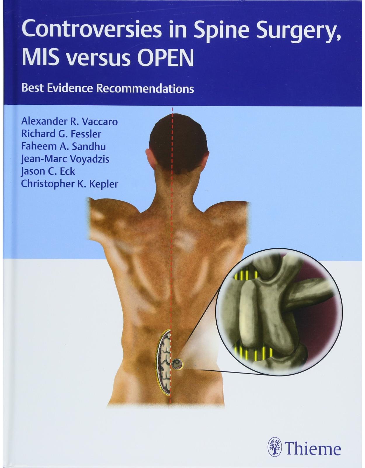 Controversies in Spine Surgery, MIS versus OPEN: Best Evidence Recommendations