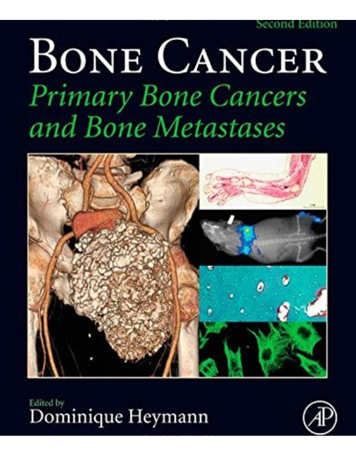 Bone Cancer, Second Edition: Primary Bone Cancers and Bone Metastases