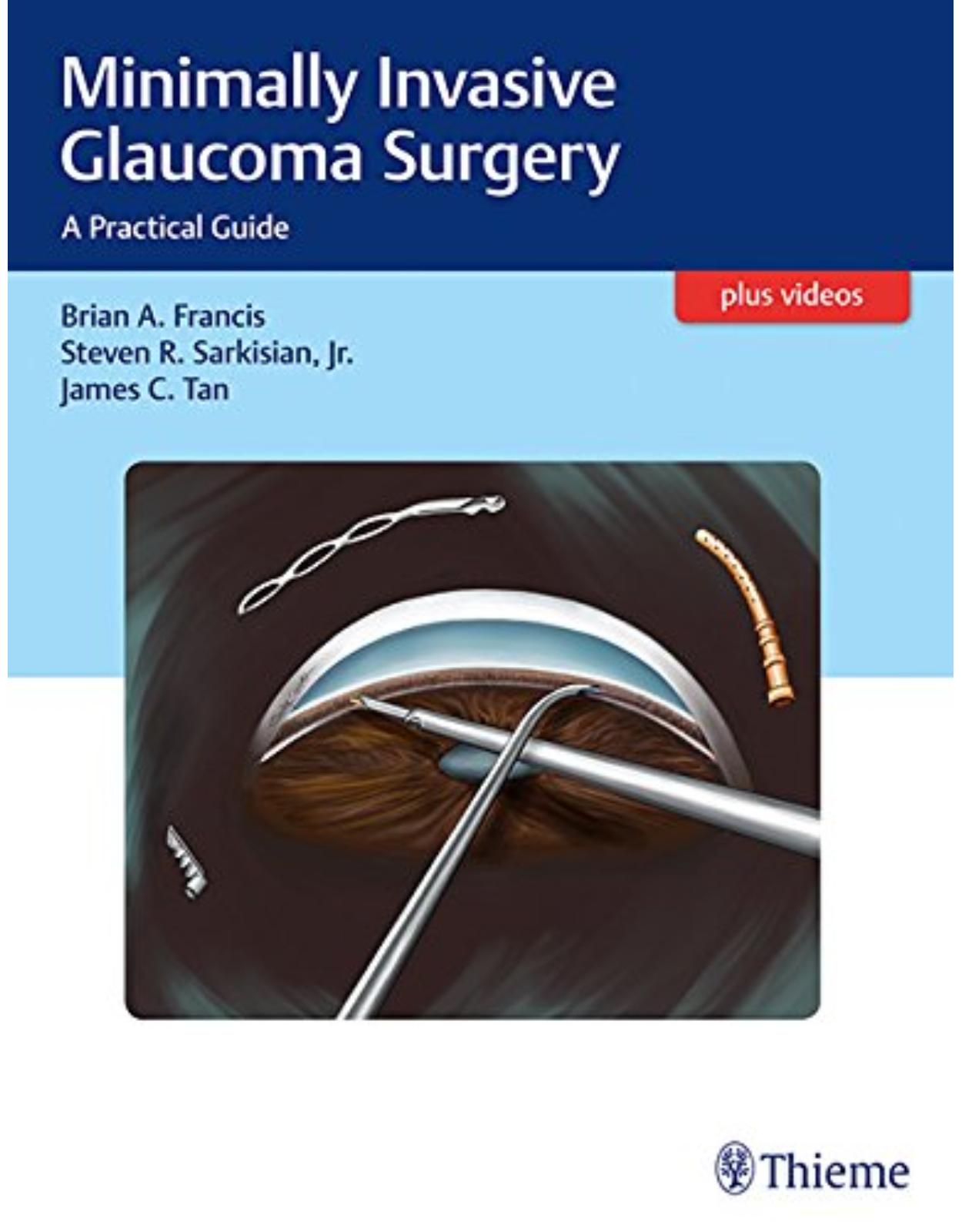 Minimally Invasive Glaucoma Surgery: A Practical Guide