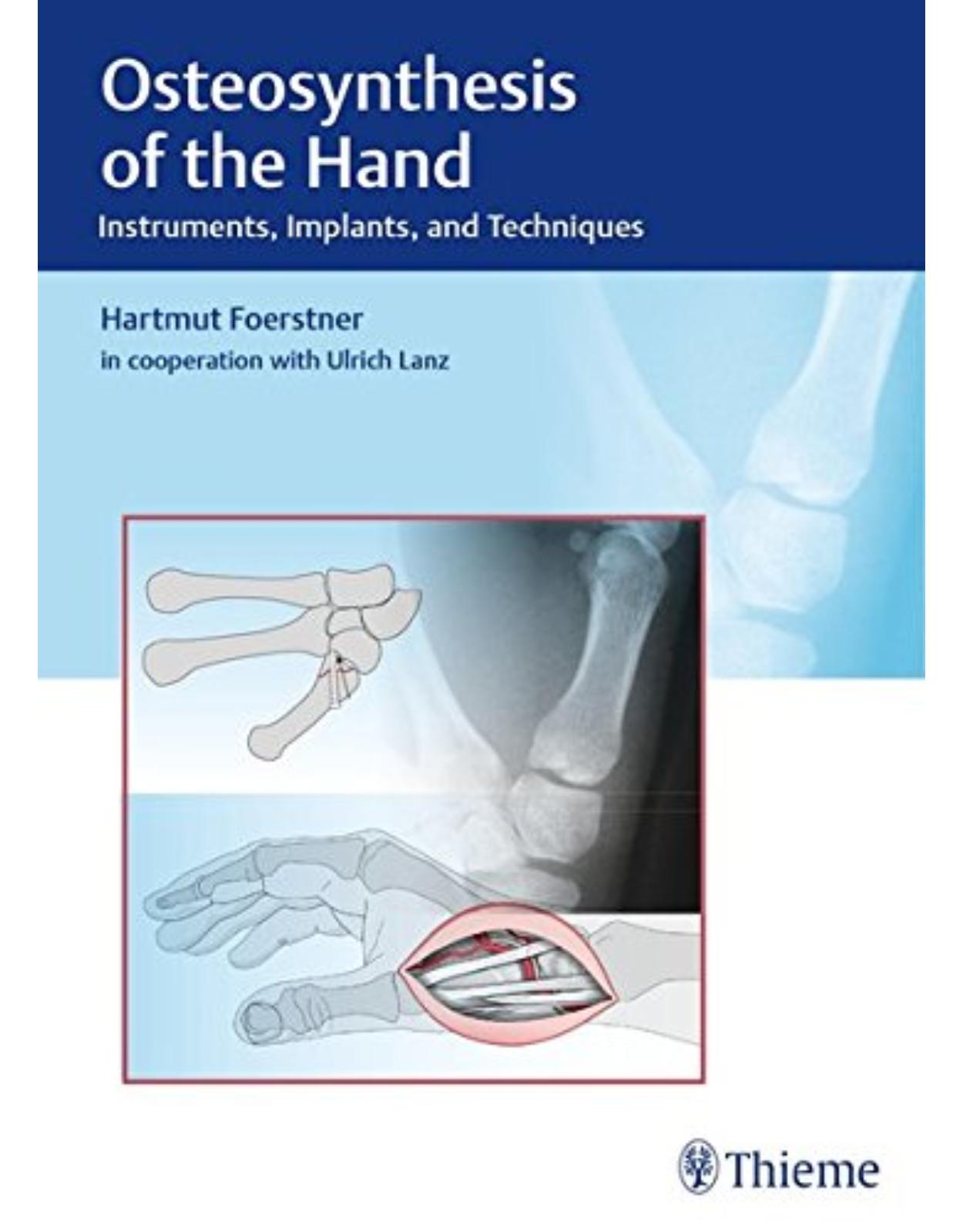  Osteosynthesis of the Hand