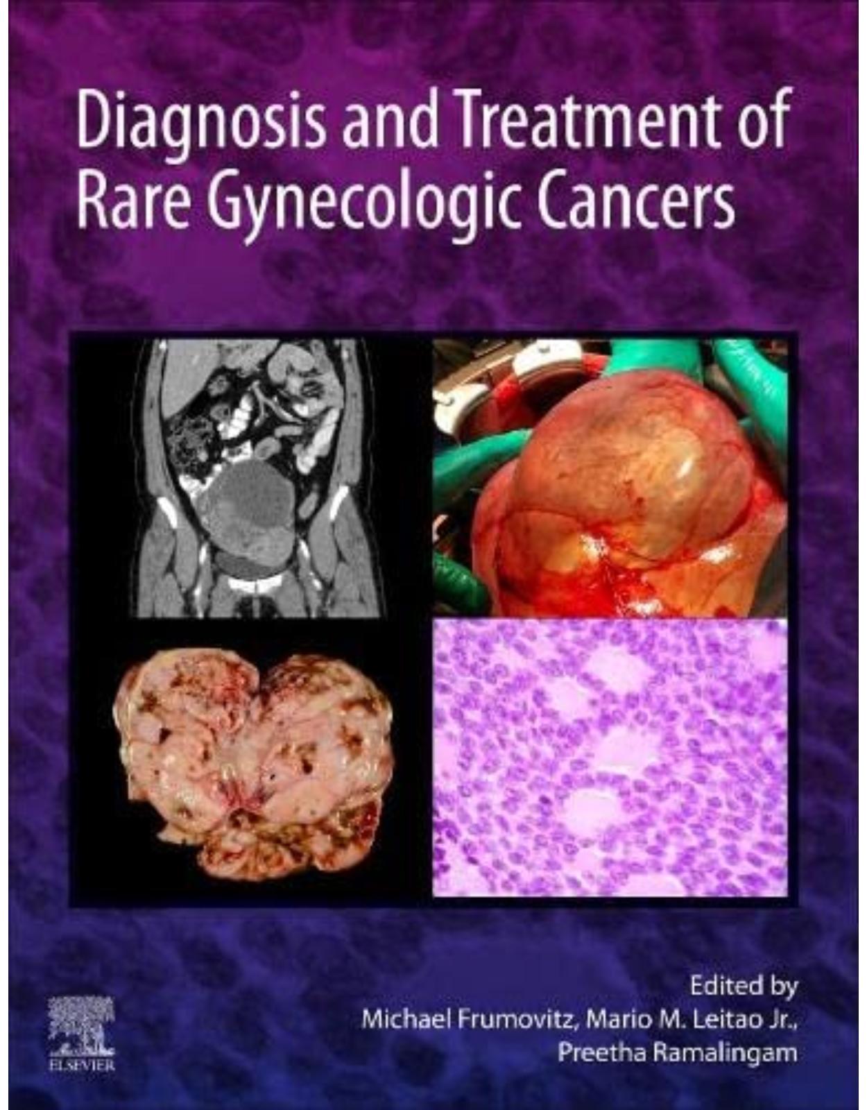 Diagnosis and Treatment of Rare Gynecologic Cancers