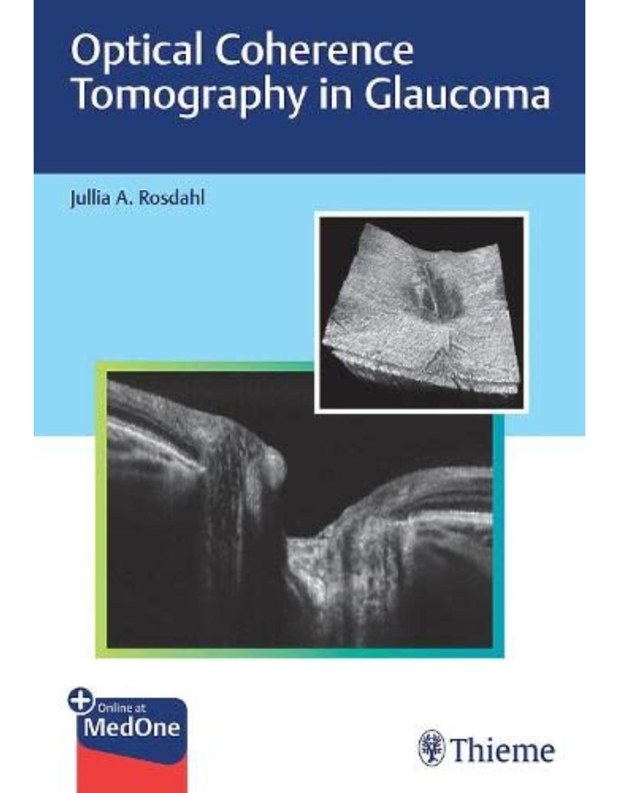 Optical Coherence Tomography in Glaucoma