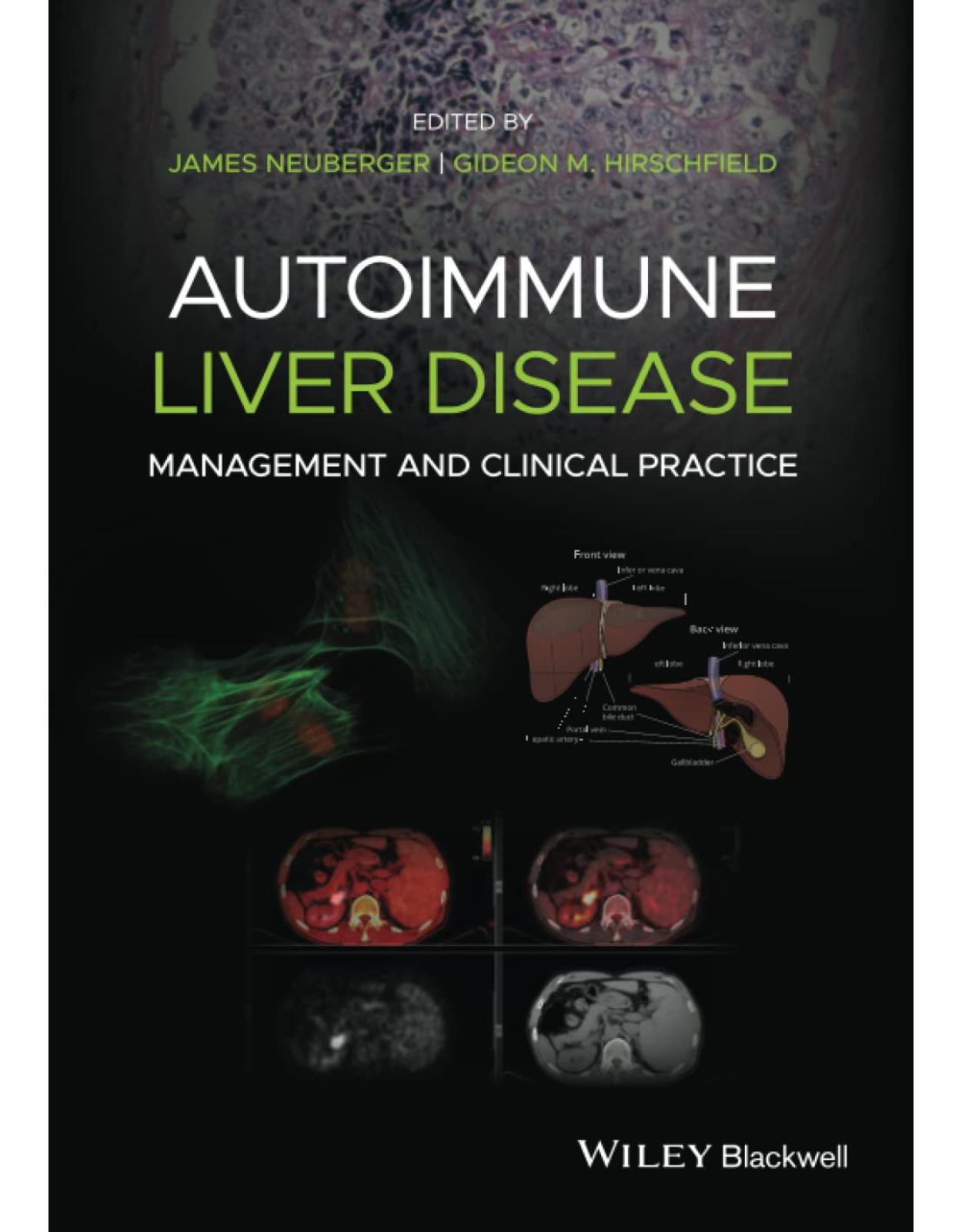 Autoimmune Liver Disease: Management and Clinical Practice