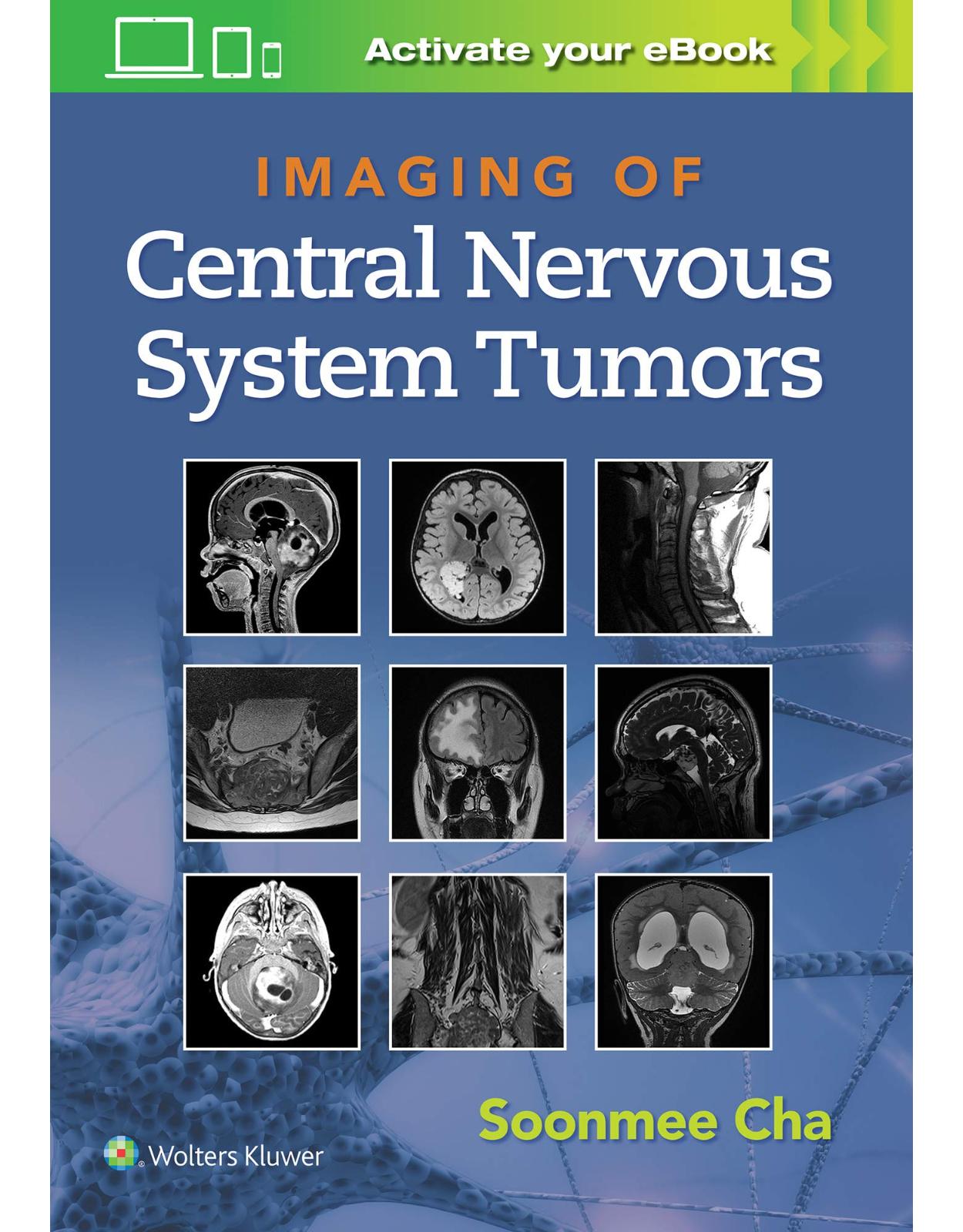 Imaging of Central Nervous System Tumors