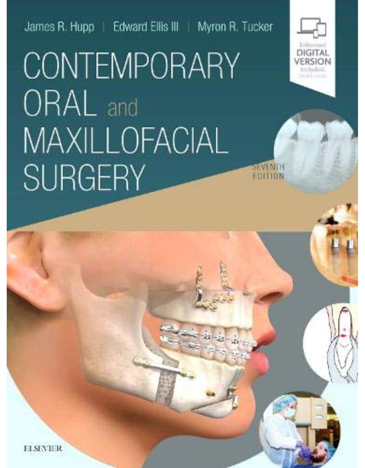 Contemporary Oral and Maxillofacial Surgery, 7e