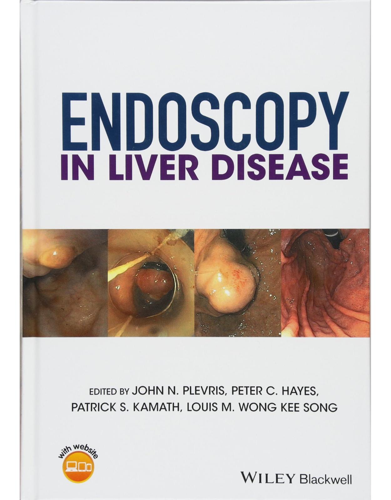 Endoscopy in Liver Disease
