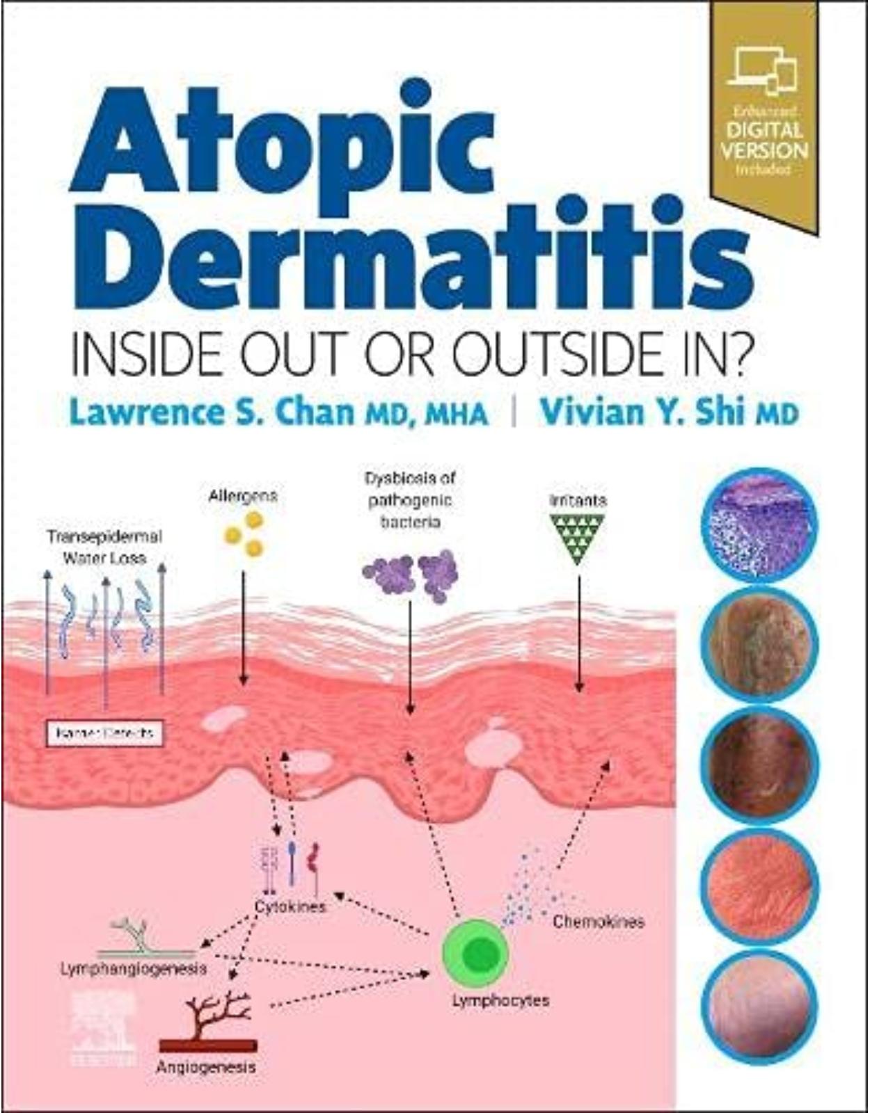 Atopic Dermatitis: Inside Out or Outside In