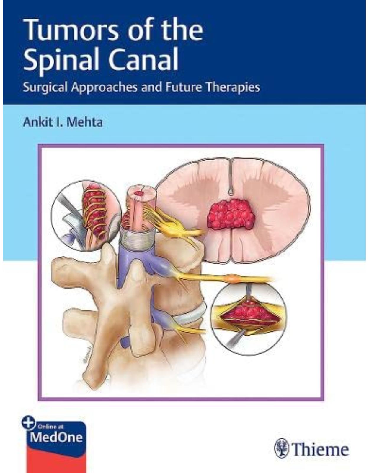 Tumors of the Spinal Canal: Surgical Approaches and Future Therapies