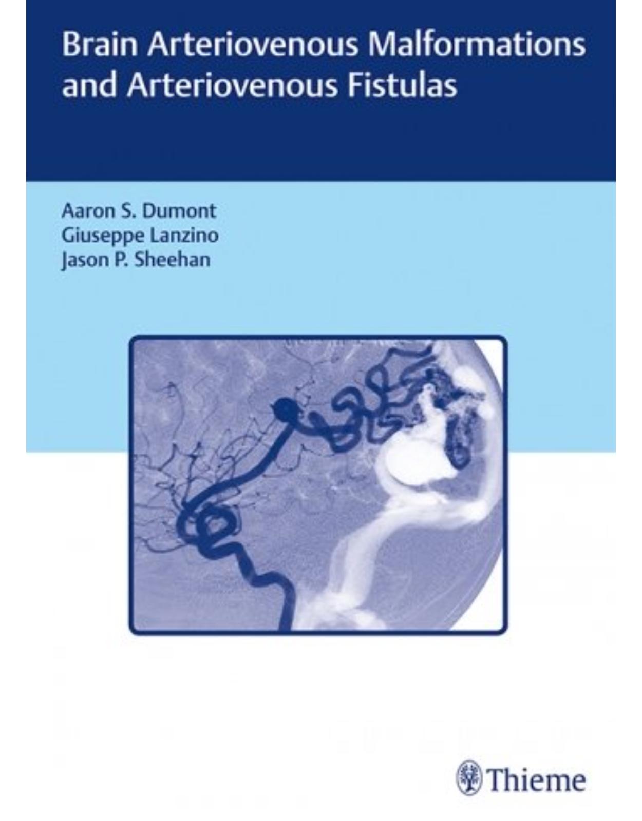 Brain Arteriovenous Malformations and Arteriovenous Fistulas