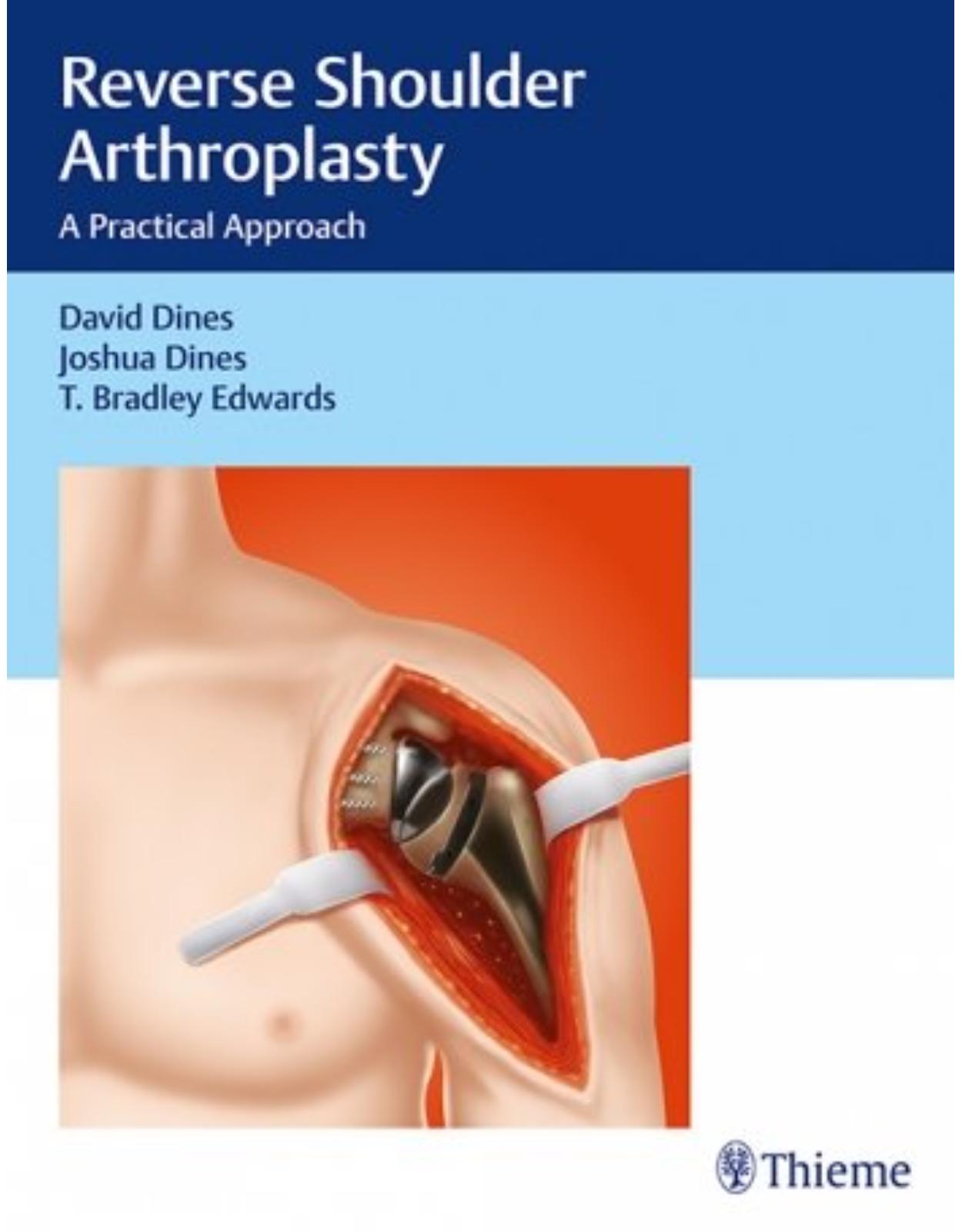 Reverse Shoulder Arthroplasty: A Practical Approach