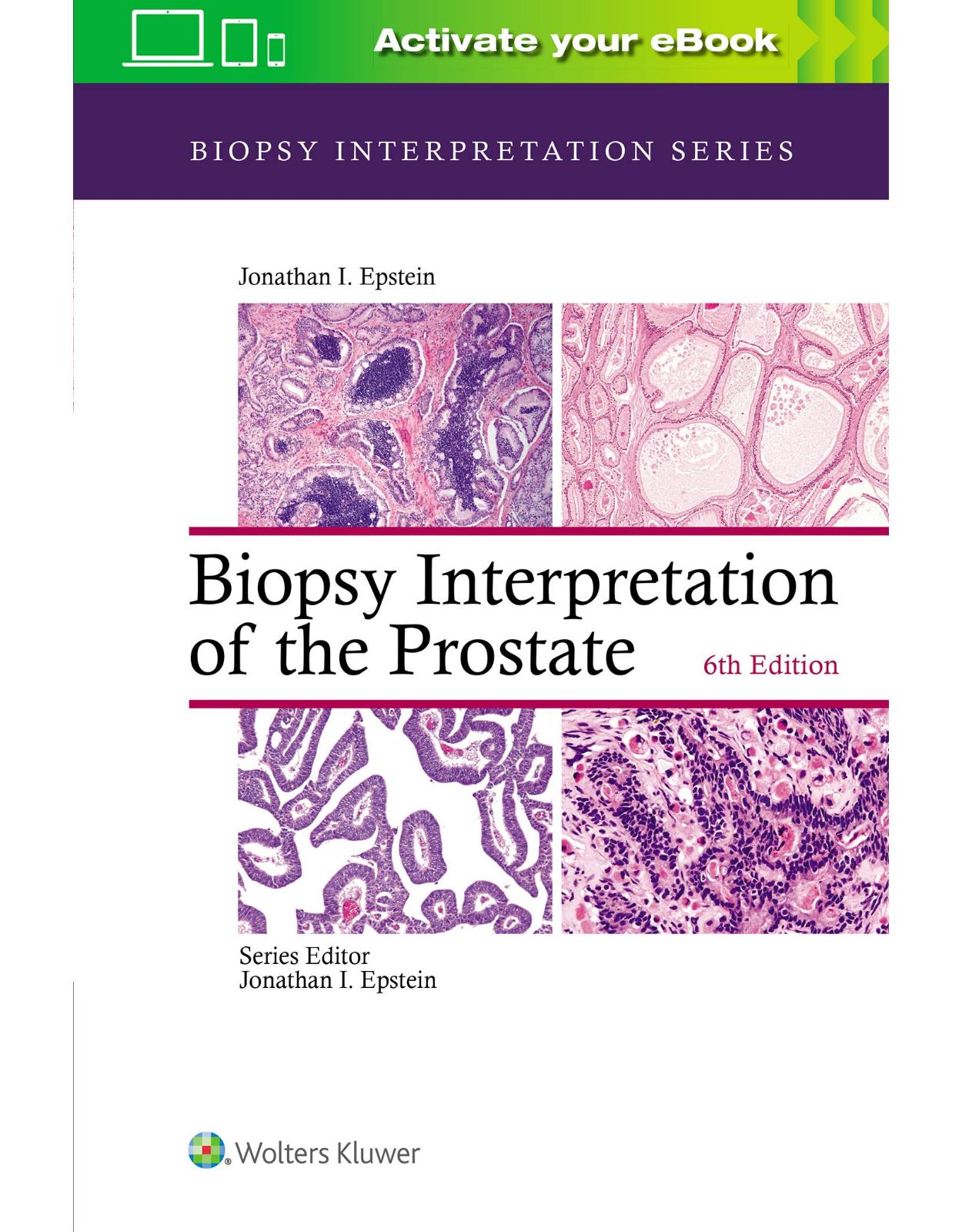 Biopsy Interpretation of the Prostate