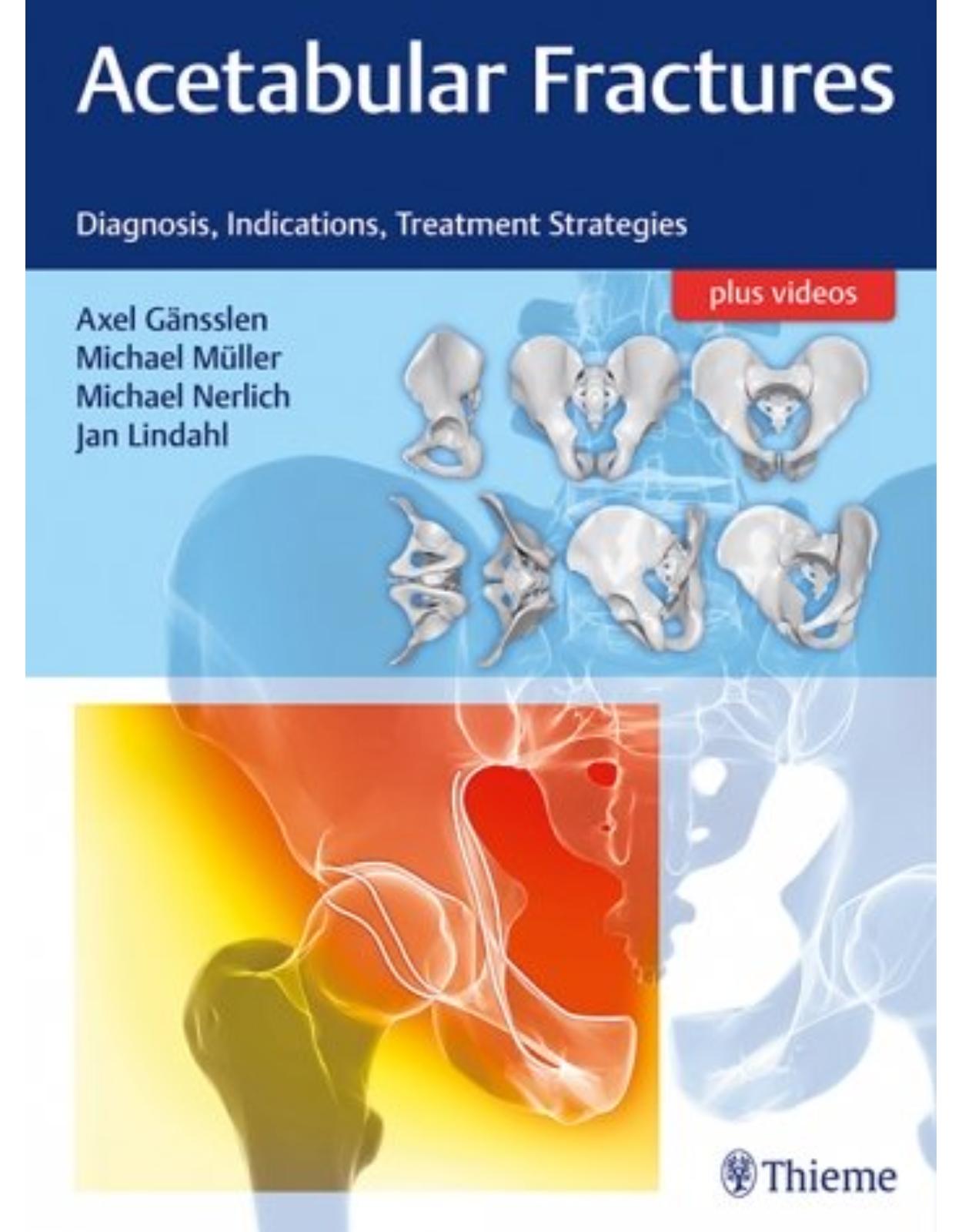 Acetabular Fractures: Diagnosis, Indications, Treatment Strategies