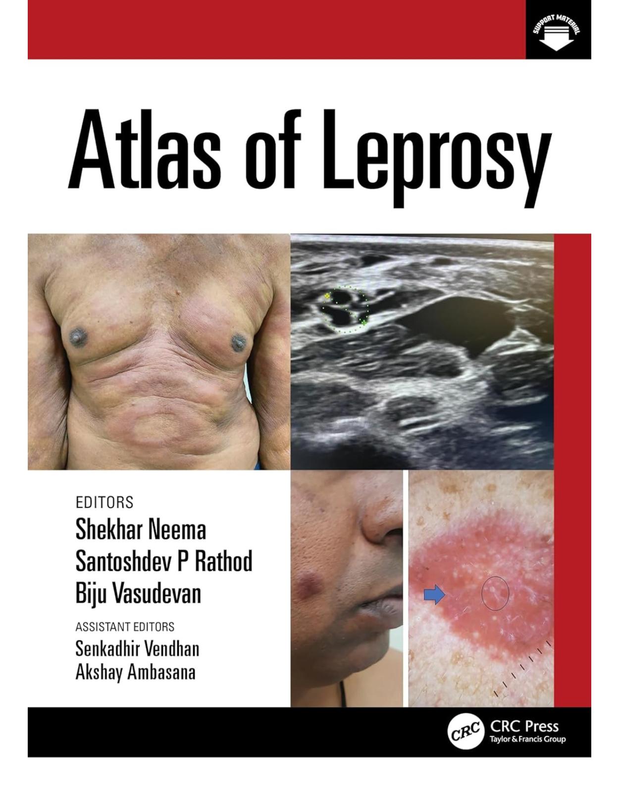 Atlas of Leprosy