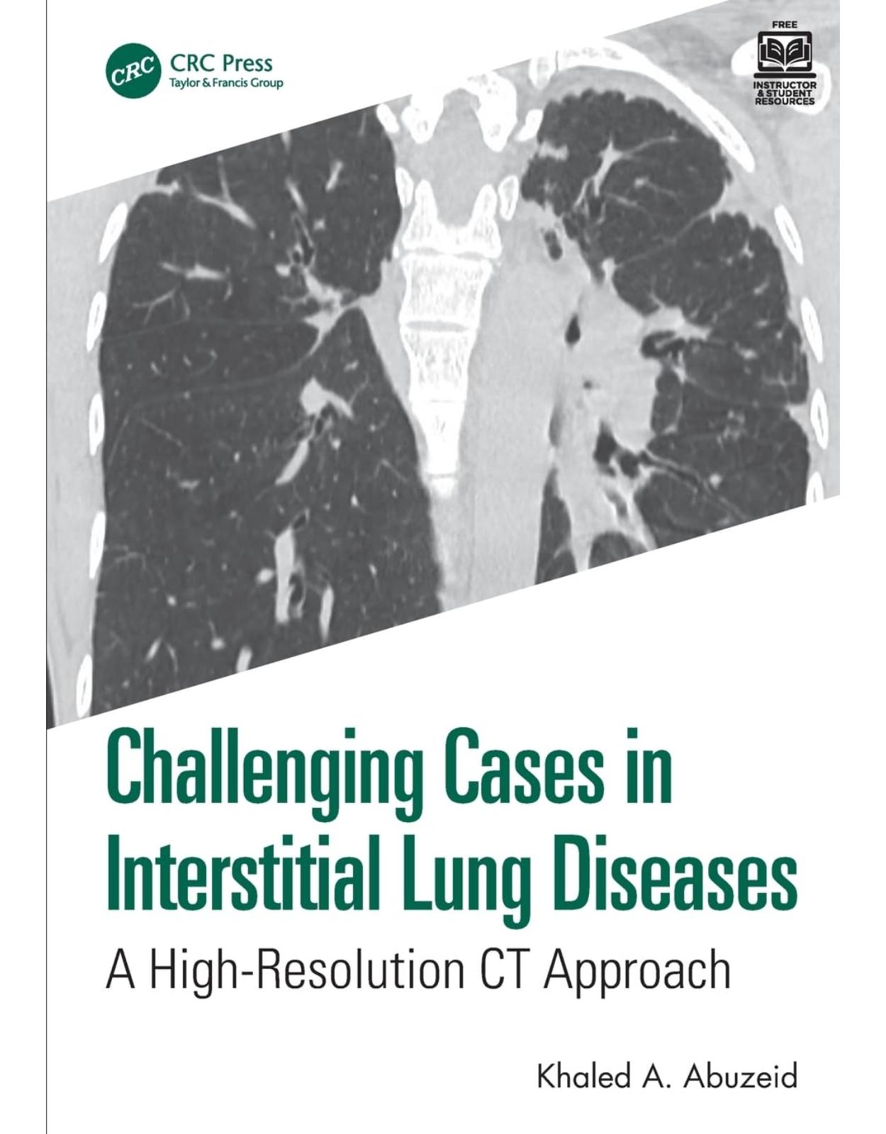 Challenging Cases in Interstitial Lung Diseases: A High-Resolution CT Approach