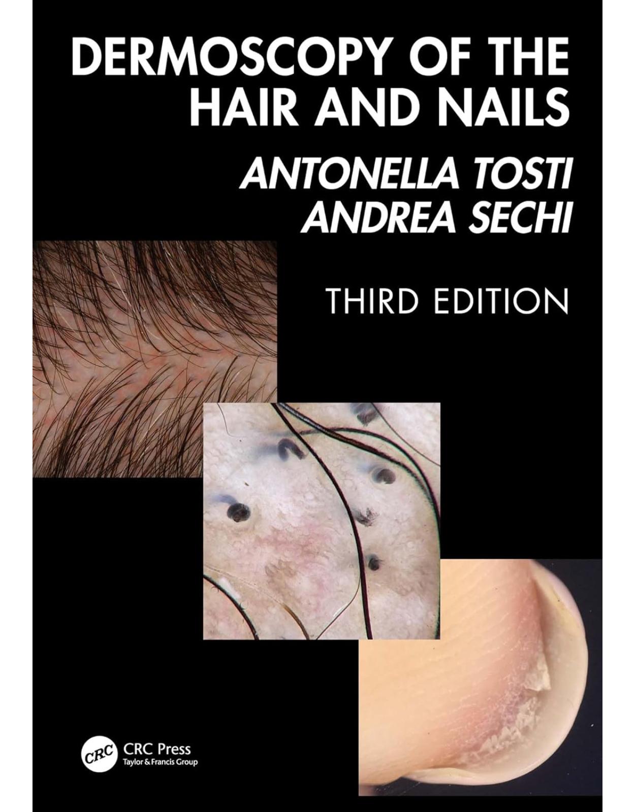 Dermoscopy of the Hair and Nails 3e 