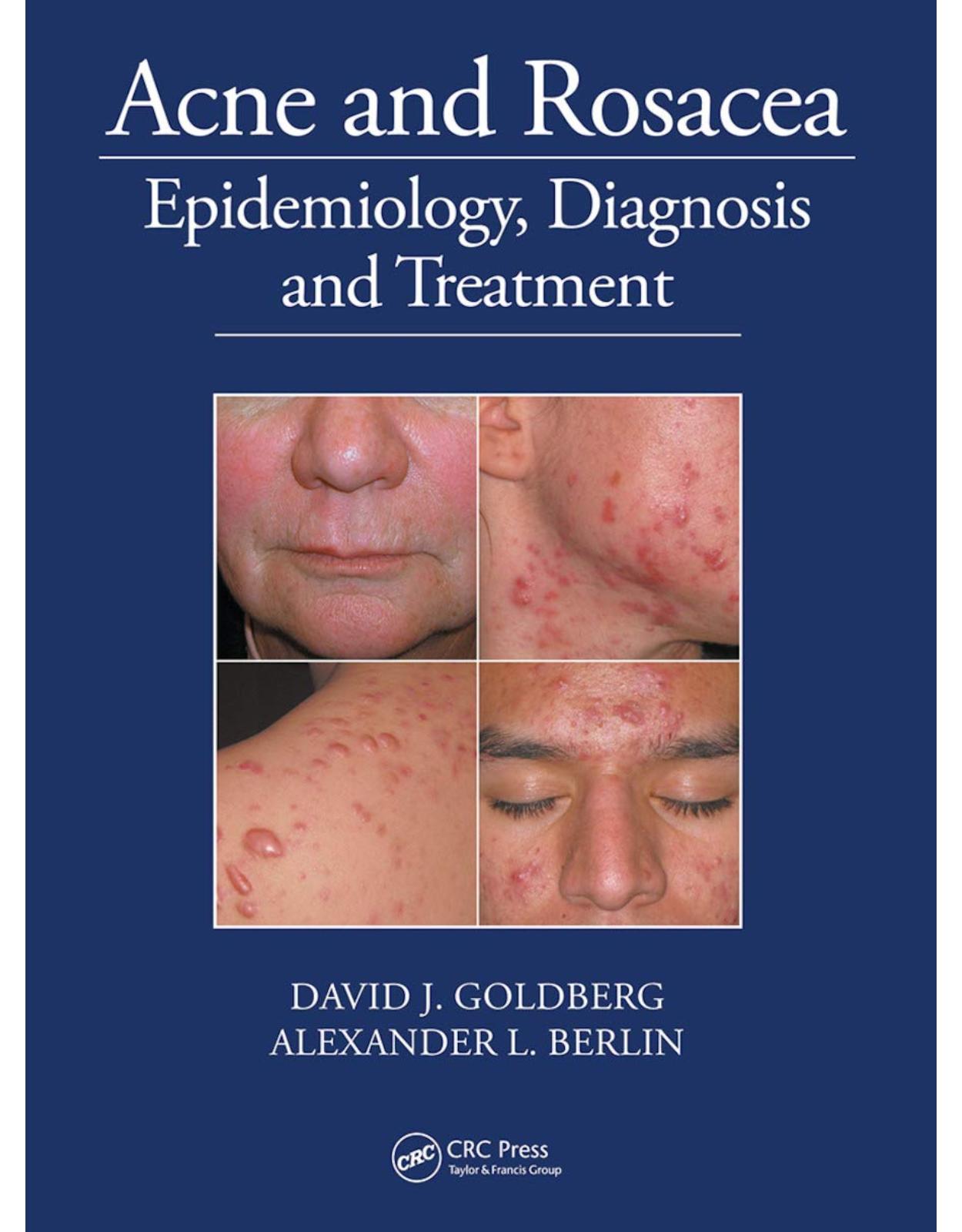 Acne and Rosacea: Epidemiology, Diagnosis and Treatment