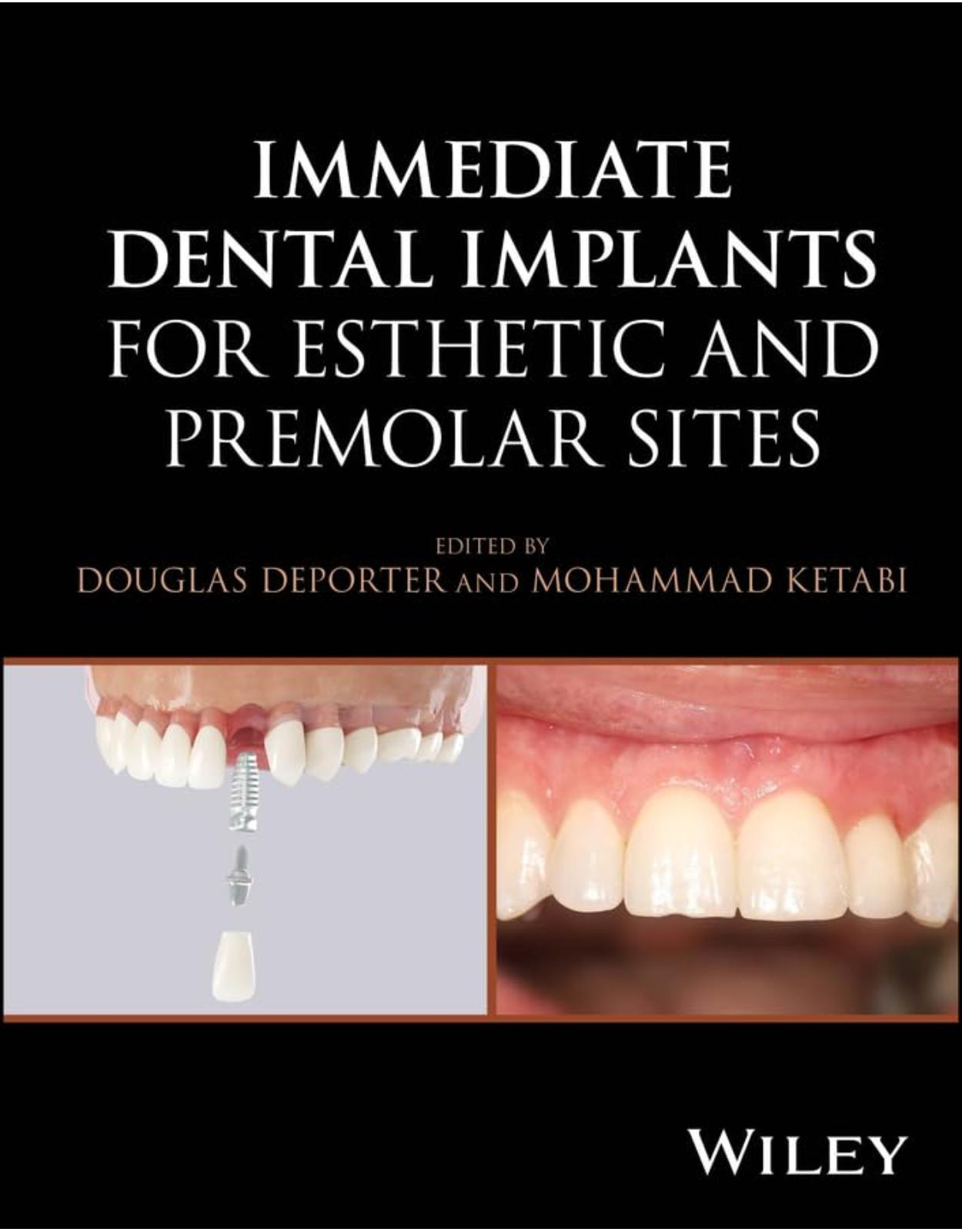 Immediate Dental Implants for Esthetic and Premolar Sites 