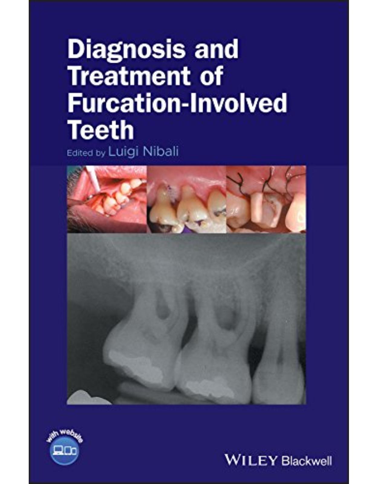 Diagnosis and Treatment of Furcation-Involved Teeth
