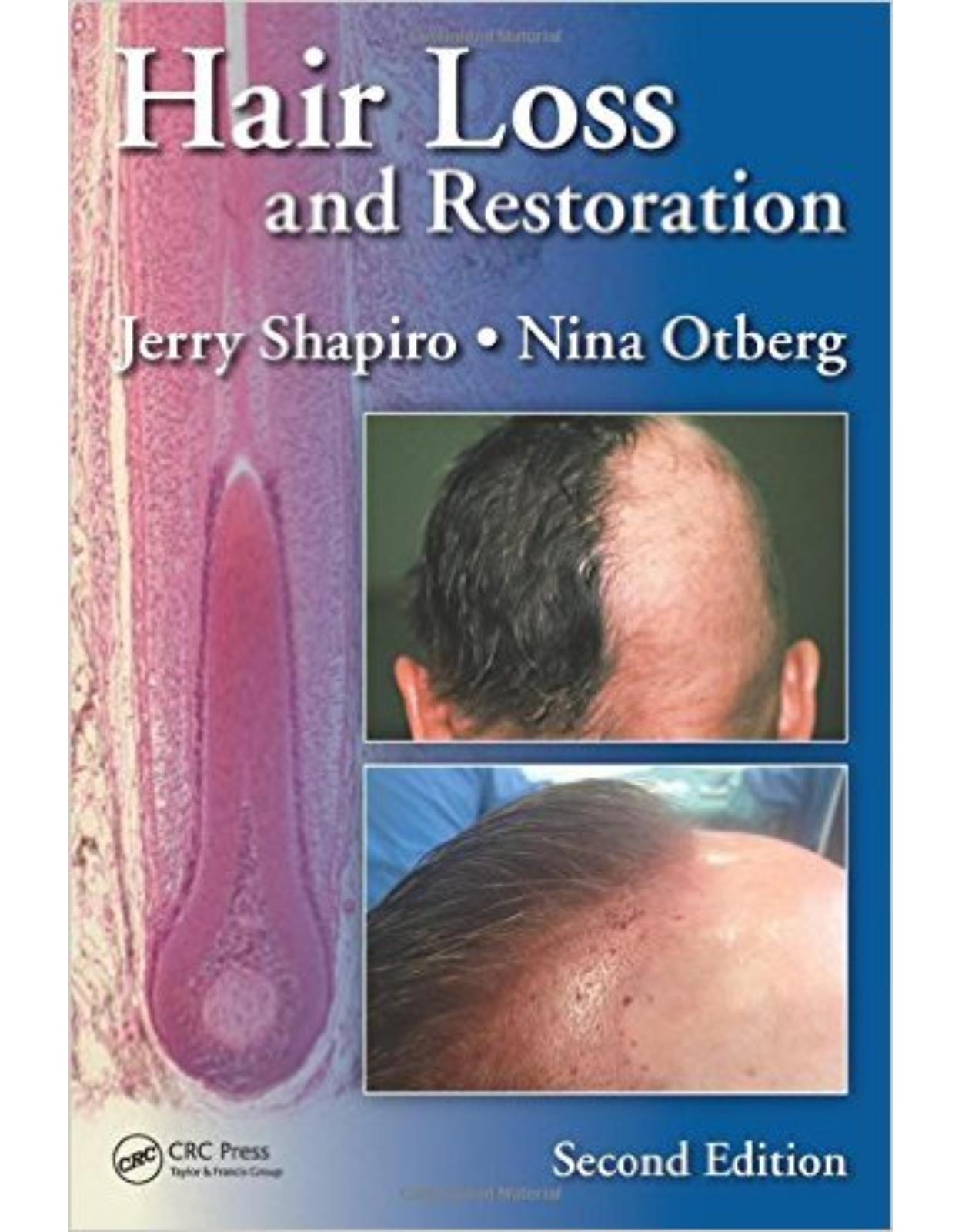 Hair Loss and Restoration, Second Edition