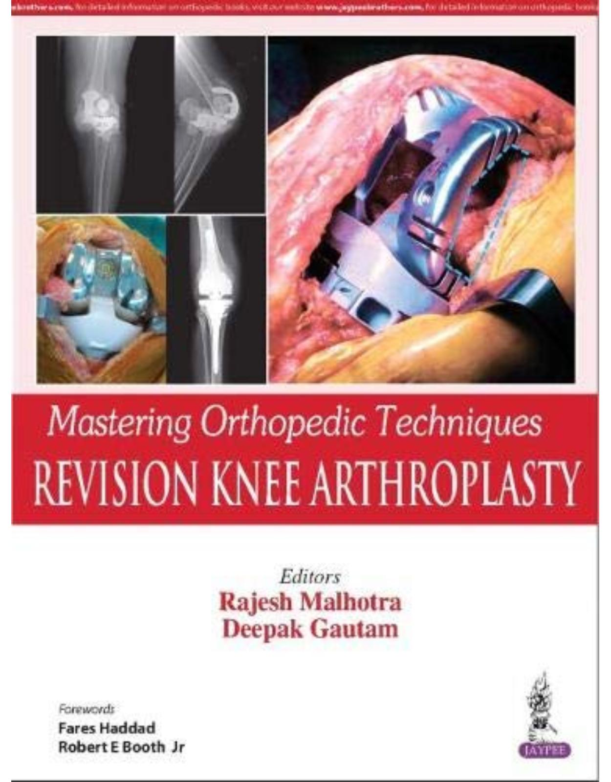 Mastering Orthopedic Techniques: Revision Knee Arthroplasty