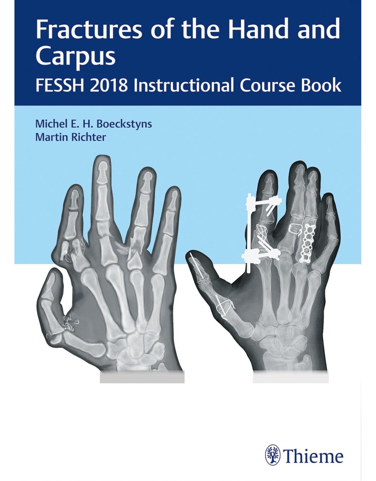 Fractures of the Hand and Carpus