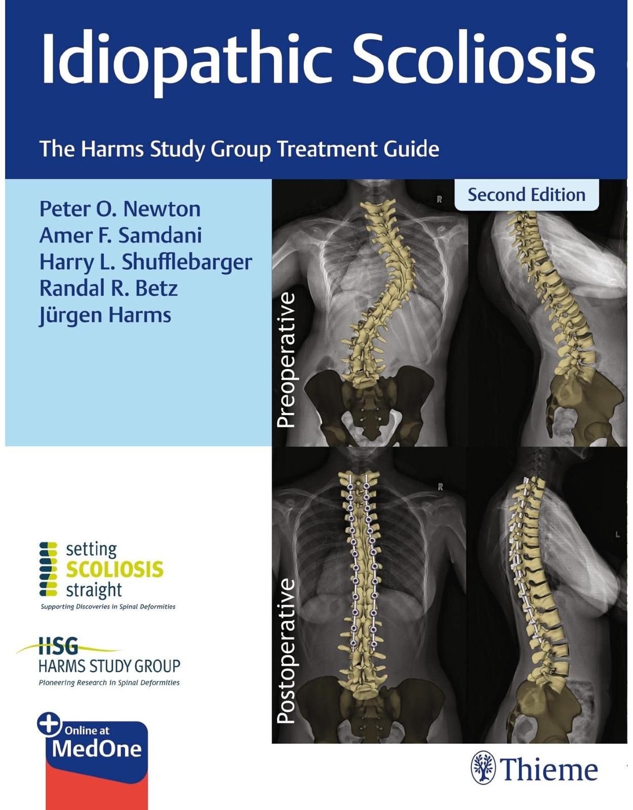 Idiopathic Scoliosis