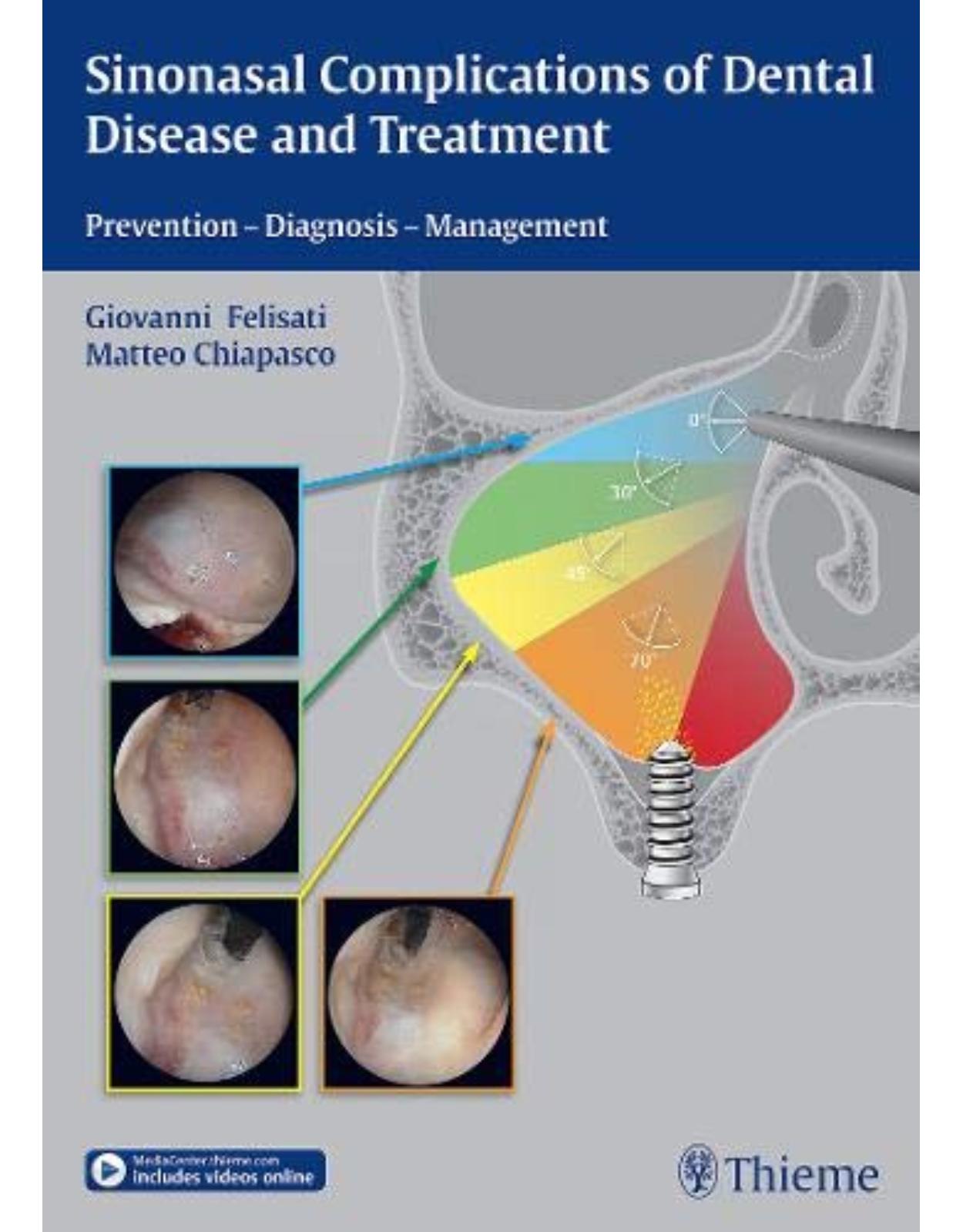 Sinonasal Complications of Dental Disease and Treatment