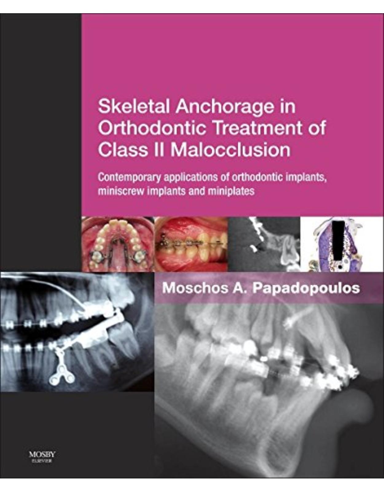 Skeletal Anchorage in Orthodontic Treatment of Class II Malocclusion