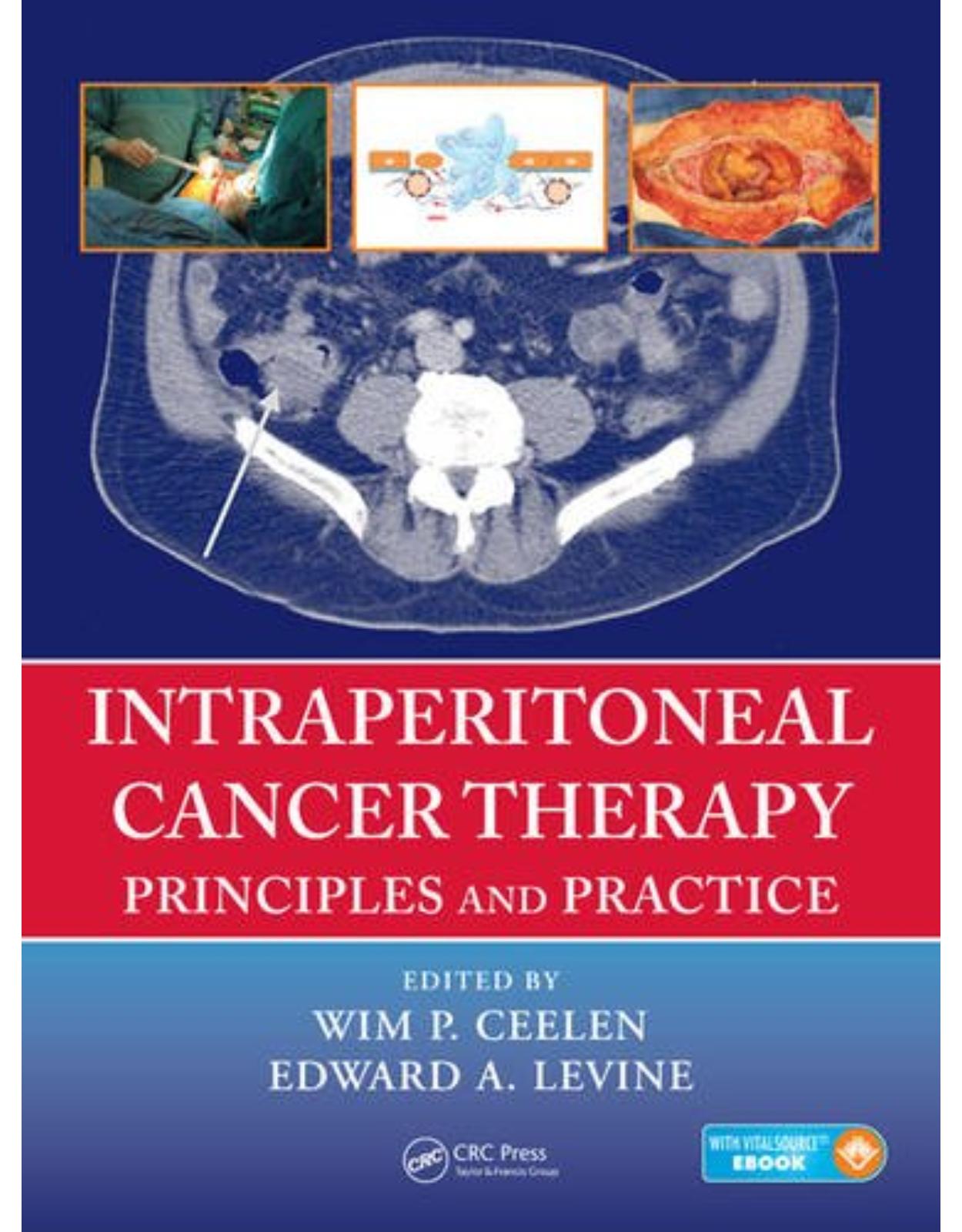 Intraperitoneal Cancer Therapy: Principles and Practice