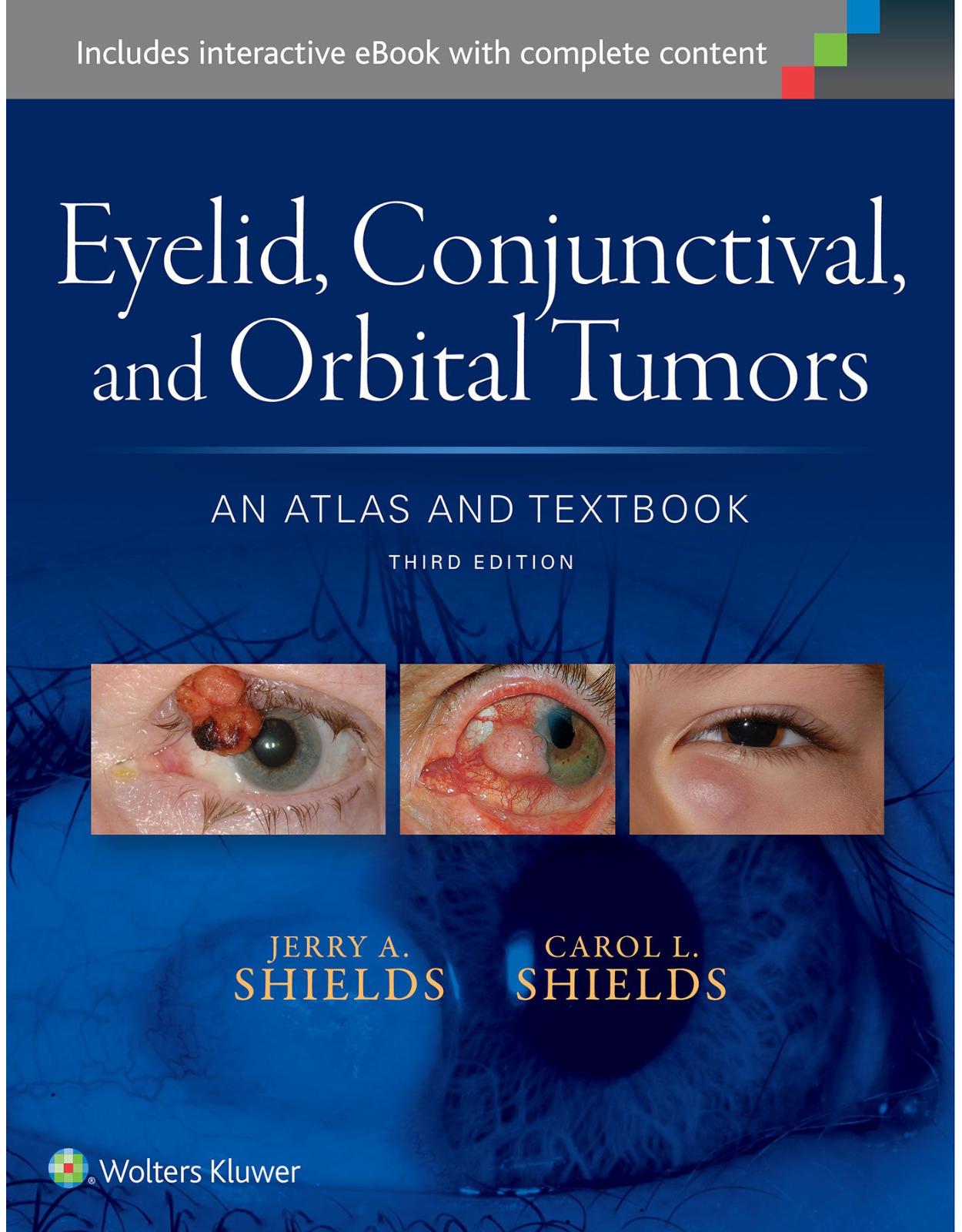 Eyelid, Conjunctival, and Orbital Tumors: An Atlas and Textbook