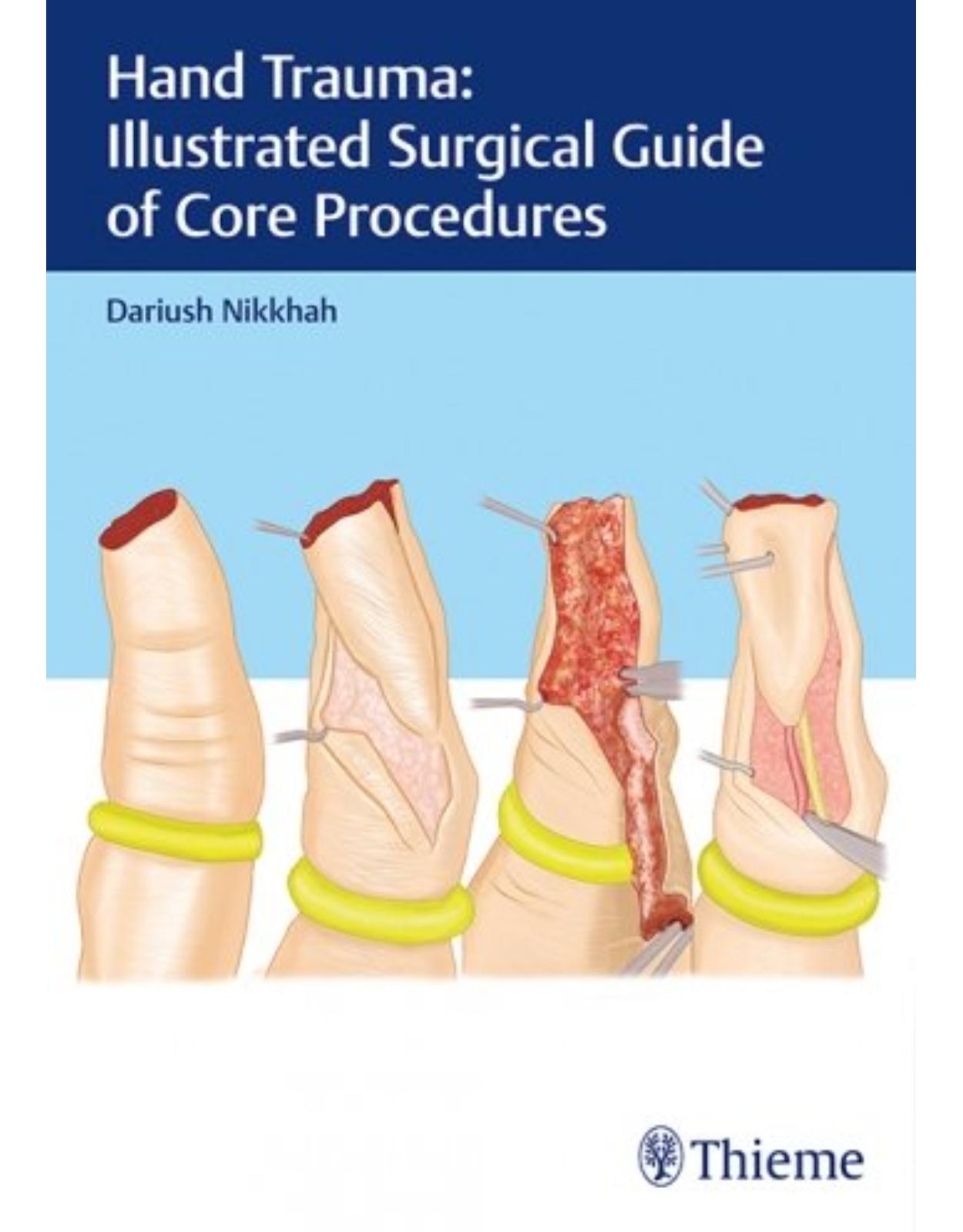 Hand Trauma: Illustrated Surgical Guide of Core Procedures