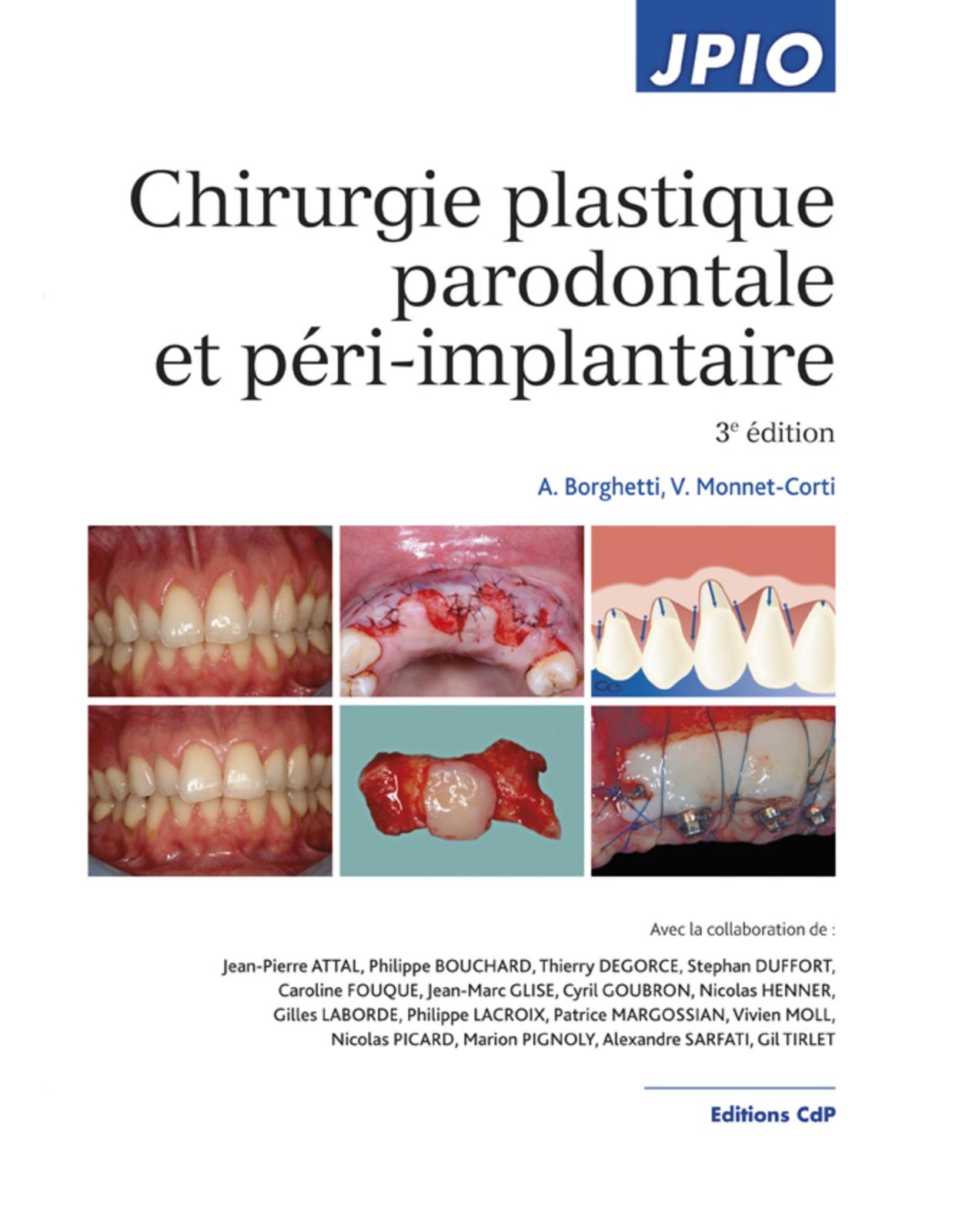 Chirurgie Plastique Parodontale Et Peri-implantaire